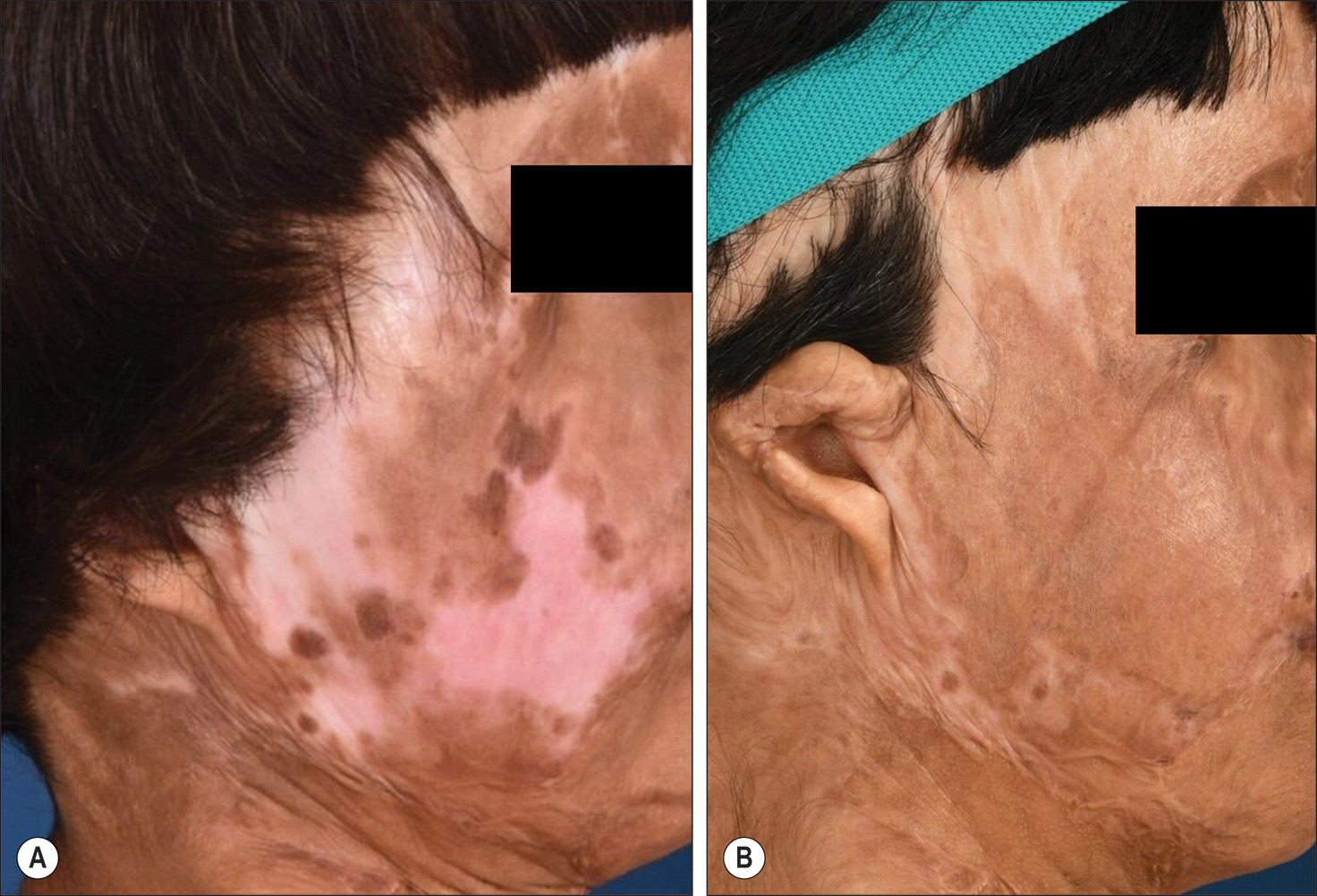 Two photos labeled A and B show secondary healing and dyspigmentation years after second and third-degree facial burns, before and after dermabrasion and thin epithelial grafts. The two photos labeled A and B show secondary healing and dyspigmentation years after second and third-degree facial burns. Photo A shows the dyspigmentation that developed years after the burns. Photo B shows late treatment results where dermabrasion and thin epithelial grafts were performed. Late treatment for dyspigmentation is recommended to allow time for possible repigmentation. If this does not occur, then treatment with dermabrasion and thin epithelial grafts can be done, as was done in this patient.
