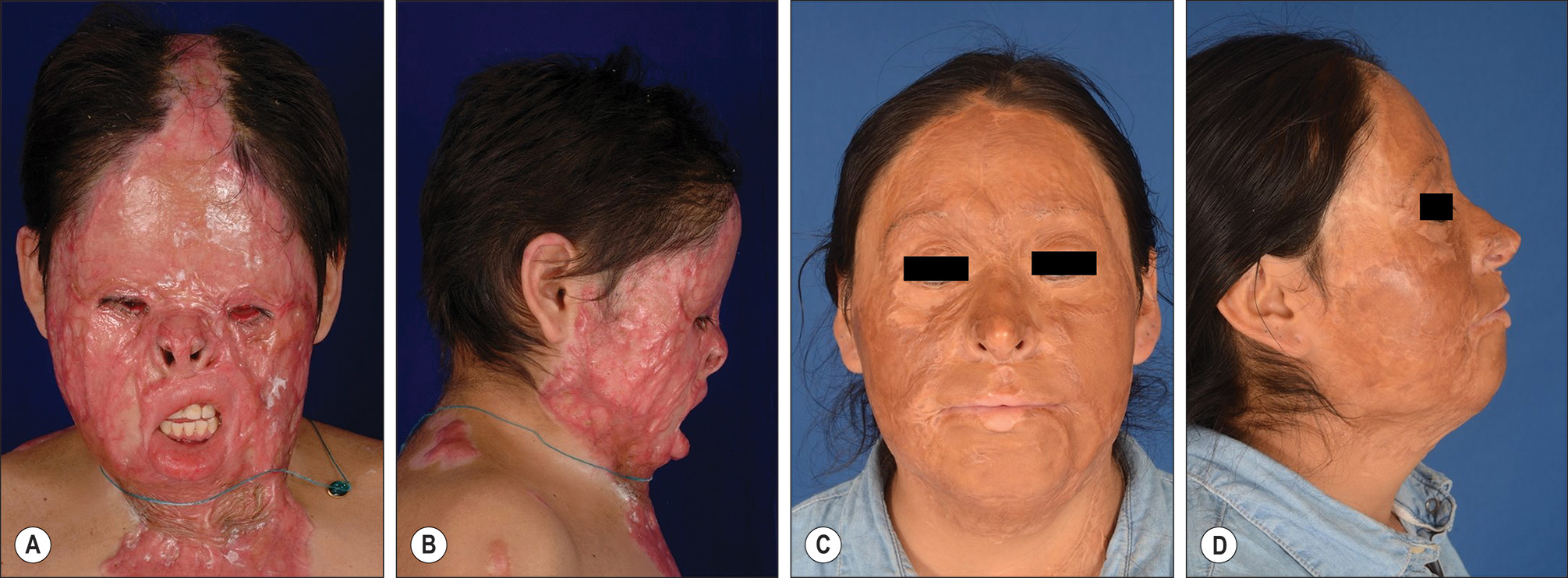 Four photos labeled A through D of severe burn deformities in a thirteen-year-old female with forty-five percent total burn surface area before and after ten years of serial reconstruction. The four photos labeled A through D show severe burn deformities in a thirteen-year-old female with forty-five percent total burn surface area that resulted from a house fire. Photos A and B show facial burn stigmata, including left eye ectropion, shortened nose with ala flaring, retruded upper lip with philtral column loss, flattened facial features, and loss of jawline definition. Photos C and D show her appearance after ten years of serial reconstruction, which included extensive split-thickness skin grafts and full-thickness skin grafts, tissue-expanded chest flap to neck, and scalp flap to nasal tip.