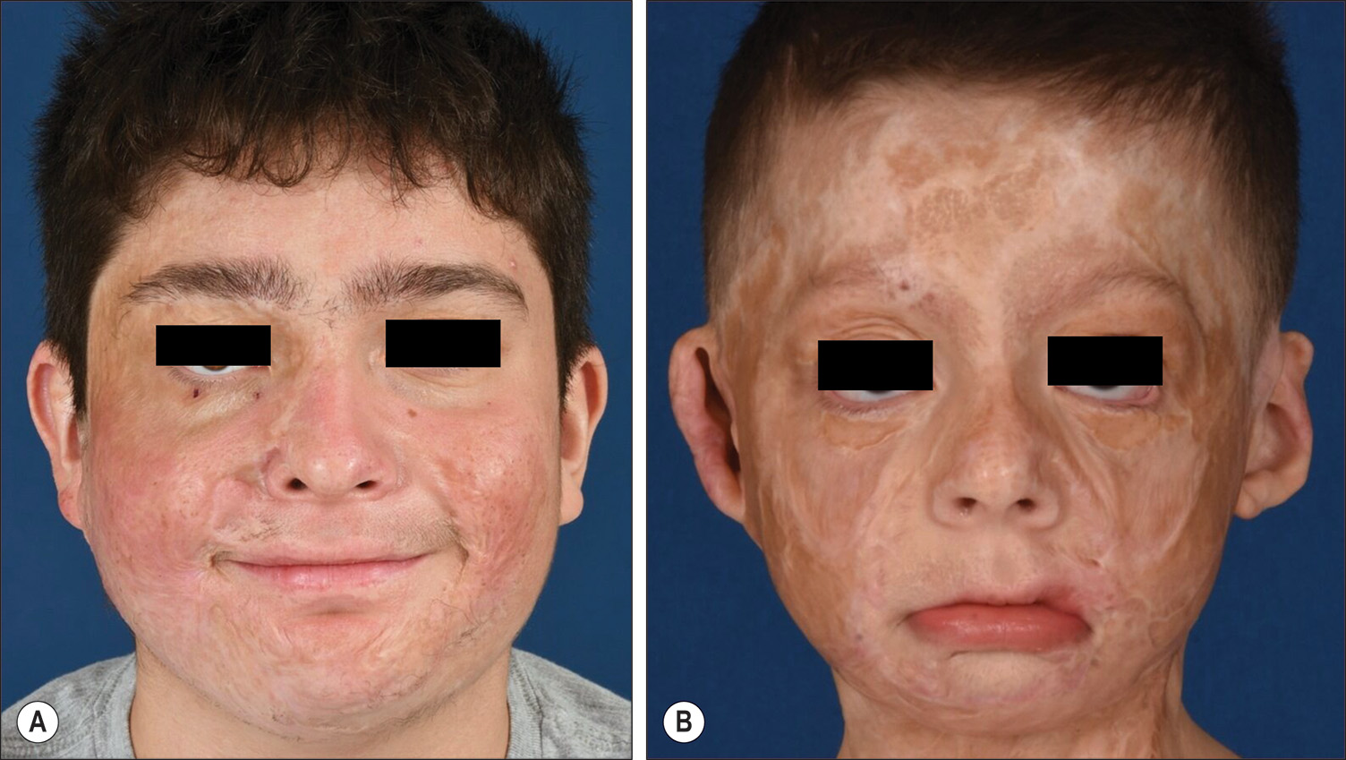 Two photos labeled A and B show diffuse extrinsic contractures in a child with right eye scleral show and bilateral lower eyelid ectropion. The two photos labeled A and B show diffuse extrinsic contractures in a child. Photo A shows the contractures resulting in right eye scleral show. Photo B shows the contractures resulting in bilateral lower eyelid ectropion.