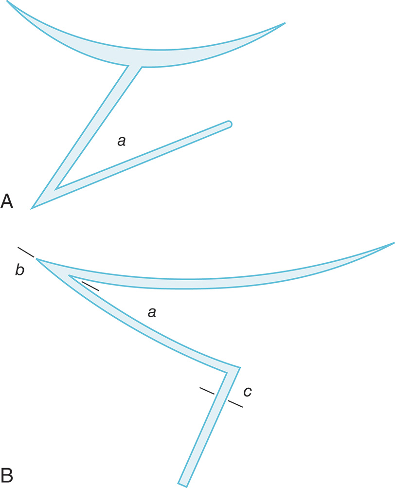 Two diagrams labeled A and B showing Horner's surgical technique to correct ectropion with flap transposition from cheek to lower eyelid. The diagrams show Horner's figures of his surgery to correct ectropion, which are considered the first reported case of a Z-plasty, although the term was not used until the early twentieth century. Diagram A shows a curved line at the top and a triangular flap below, labeled with point a at the apex and point A at the bottom left. Diagram B shows a curved line at the top labeled b, a triangular area labeled a in the middle, and angular flaps with points labeled b and c. In Diagram B, flap a was taken from the cheek and transposed to the lower eyelid. Pins were placed at b and c to keep the flaps in place.