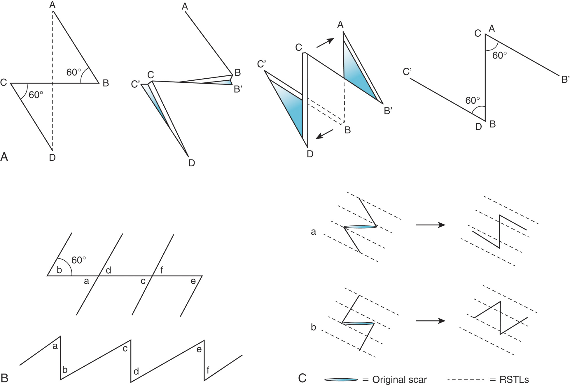 Three diagrams labeled A, B, and C showing Z plasty surgical techniques, including classic Z plasty, serial Z plasties, and two flap orientation options. The diagrams show classic Z-plasty, serial Z-plasties, and Z-plasty options. Diagram A shows classic Z-plasty with a series of angular flaps and arrows indicating the direction of transposition. Diagram B shows serial Z-plasties resulting in elongation of the limbs and transposition of quadrangular flaps, with multiple connected angular patterns. Diagram C shows two options for a Z-plasty, with option a labeled as Original scar with dotted lines and option b labeled as Matured scar with dotted lines. Option a produces a better orientation of the flaps than option b.