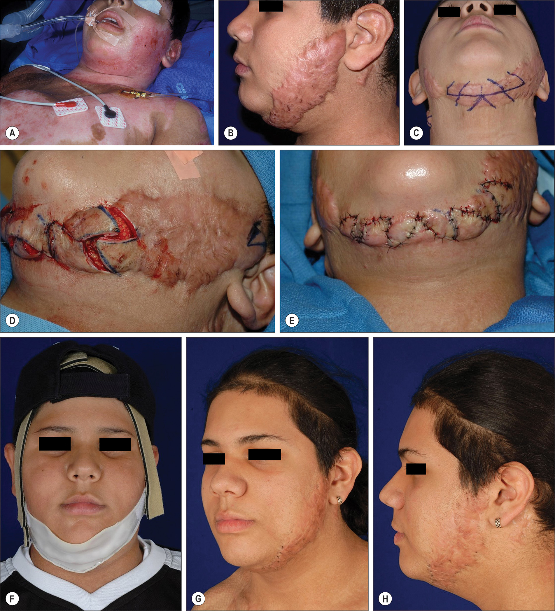A photo series of 8 photos labeled A through H showing a 10 year old male with 40 percent total body surface area electrical and flame burn and treatment progression over years. The photo series of 8 photos labeled A through H shows a 10-year-old male with 40 percent total body surface area electrical and flame burn and treatment progression over the years. Photo A shows the patient after the burn injury. Photo B shows left face hypertrophic scarring 2 years after injury. Photos C through E show multiple intrascar Z plasties performed to decrease tension on the scar. Photo F shows the patient undergoing pressure therapy. Photos G and H show results 4 years after Z plasties and 2 scar treatments with pulsed dye laser to decrease erythema.