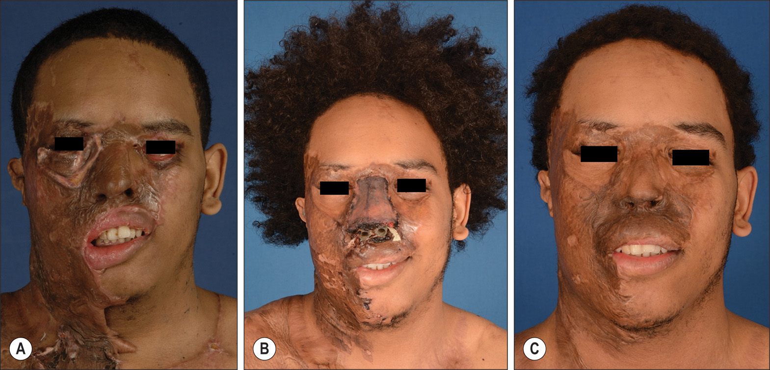 A photo series of 3 photos labeled A through C showing acid burn to the right face, neck, and chest with nasal dorsum scarring treatment and progression over 1 year. The photo series of 3 photos labeled A through C shows acid burn to the right face, neck, and chest requiring treatment of external auditory meatus closure, ectropion, and nasal stenosis. Photo A shows scarring to the nasal dorsum resulting from a third-degree burn. Photo B shows full-thickness skin grafted onto the nasal dorsum with nasal stents in place. Photo C shows the appearance about 1 year after graft placement. The patient eventually underwent a forehead flap to the nose to resurface the external skin.