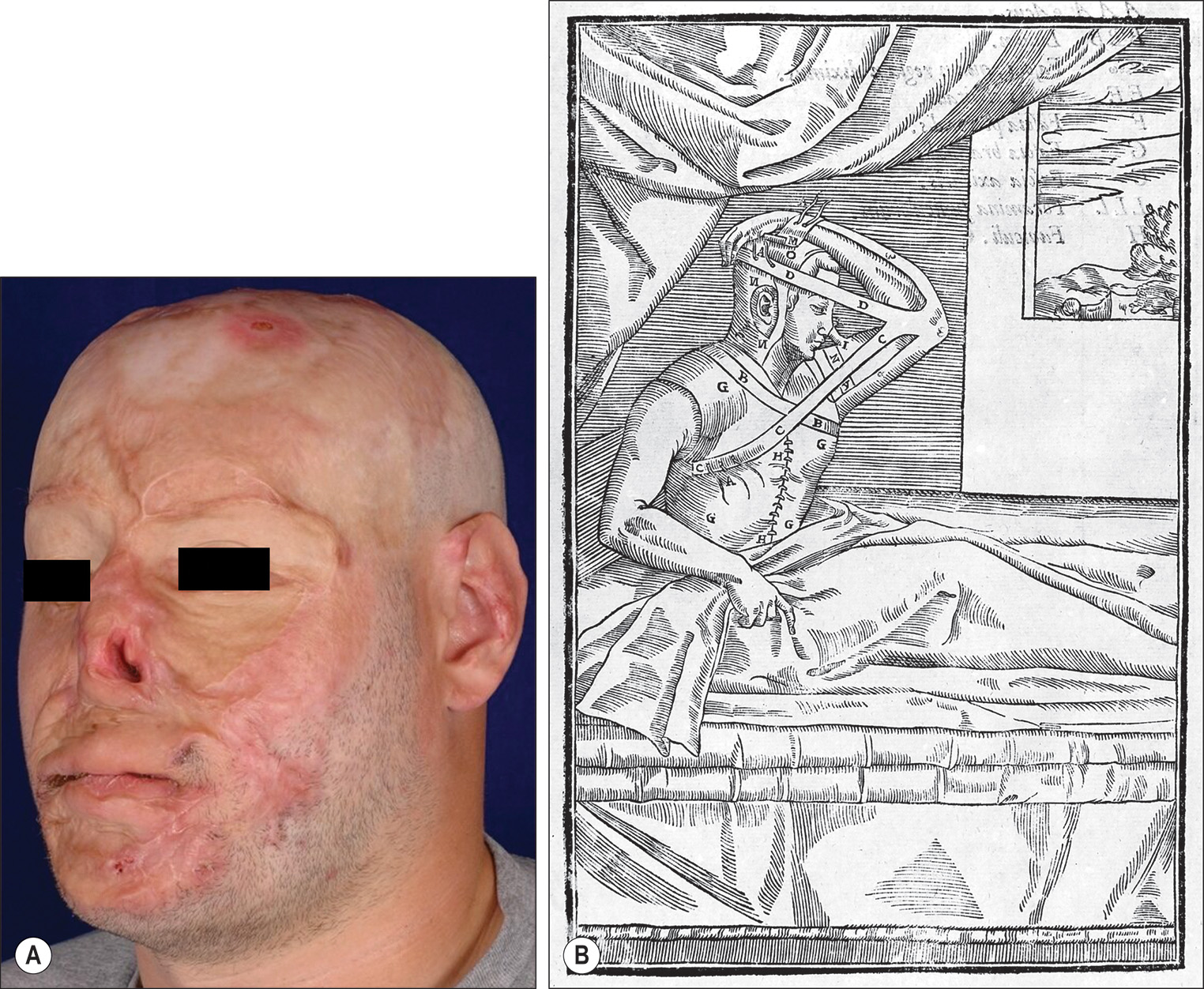 Ten panels labeled A through J showing panfacial scarring from second and third degree burns, with a historical woodcut from 1597, and a tubed pedicle flap reconstruction process. The ten panels labeled A through J show panfacial scarring from second and third-degree burns with historical and modern reconstruction techniques. Panel A shows panfacial scarring secondary to second and third-degree burns. Panel B shows a woodcut of Tagliacozzi's flap from 1597. Panels C through E show the creation of a tubed pedicle on the upper left arm. Panel F shows an inset of a tubed pedicle flap. Panel G shows stabilization of the left arm with a tubed pedicle flap in place. Panel H shows the division of the flap. Panels I and J show postoperative results.