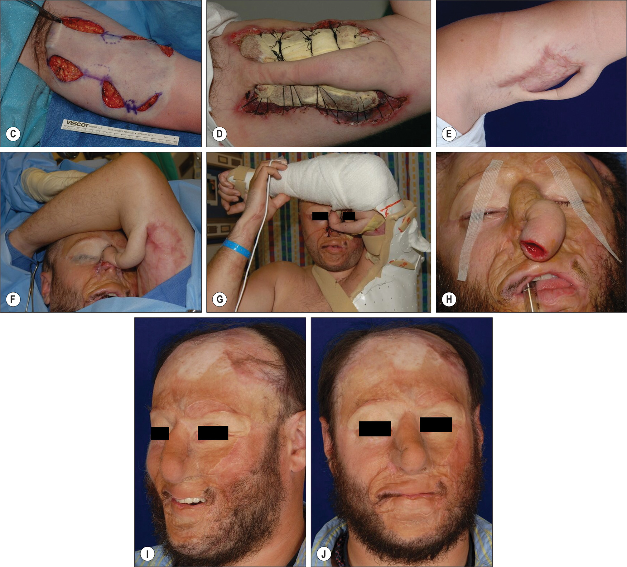 Ten panels labeled A through J showing panfacial scarring from second and third degree burns, with a historical woodcut from 1597, and a tubed pedicle flap reconstruction process. The ten panels labeled A through J show panfacial scarring from second and third-degree burns with historical and modern reconstruction techniques. Panel A shows panfacial scarring secondary to second and third-degree burns. Panel B shows a woodcut of Tagliacozzi's flap from 1597. Panels C through E show the creation of a tubed pedicle on the upper left arm. Panel F shows an inset of a tubed pedicle flap. Panel G shows stabilization of the left arm with a tubed pedicle flap in place. Panel H shows the division of the flap. Panels I and J show postoperative results.