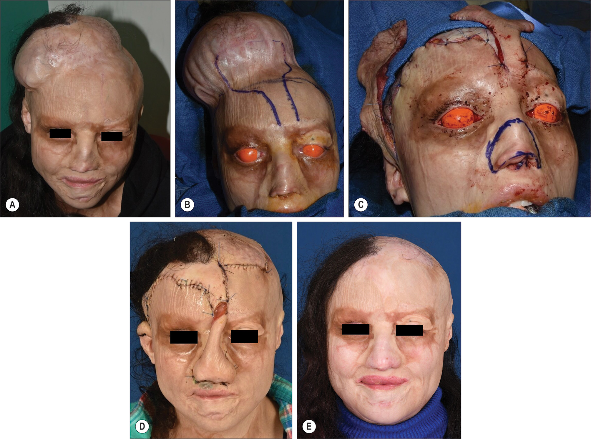 A photo series of 5 photos labeled A through E showing panfacial burn from a house fire at age 2, with nasal reconstruction using a forehead flap over 4.5 years. The photo series of 5 photos labeled A through E shows a panfacial burn from a house fire at age 2 with nasal reconstruction progression. Photo A shows the scalp tissue expander before nasal reconstruction. Photos B and C show the forehead flap design and multiple surgical delay procedures to ensure scar flap survival. Indocyanine green evaluation was used intraoperatively to safeguard flap survival. Photo D shows the postoperative result with the forehead flap in place. Photo E shows the patient 4.5 years after forehead flap index surgery. The patient later had cadaveric cartilage placement to the nose to improve airway and aesthetics. Cartilage has not resorbed.