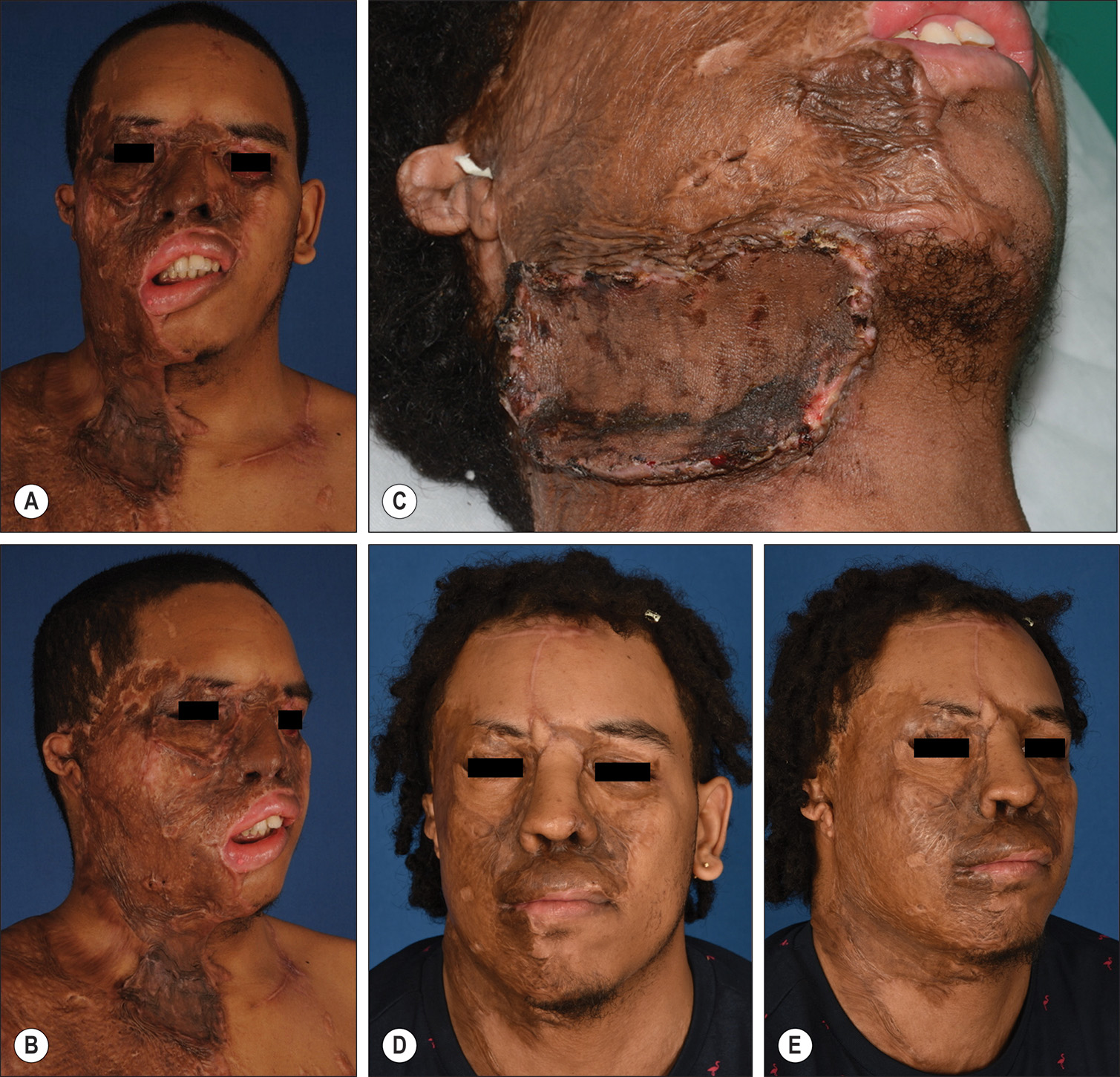 A photo series of 5 photos labeled A through E showing acid burn to the right face, neck, and chest, with neck contracture release and reconstruction over 3 years. The photo series of 5 photos labeled A through E shows acid burn to the right face, neck, and chest with treatment progression. Photos A and B show neck contracture causing severe mouth distortion and oral incompetence. Photo C shows tissue expanded left neck with local flap to right neck, followed by split-thickness skin graft placed after neck contracture release. Full-thickness skin graft was also placed on the right lower lip. Photos D and E show about 3 years postoperative results with the restored position of both lips.