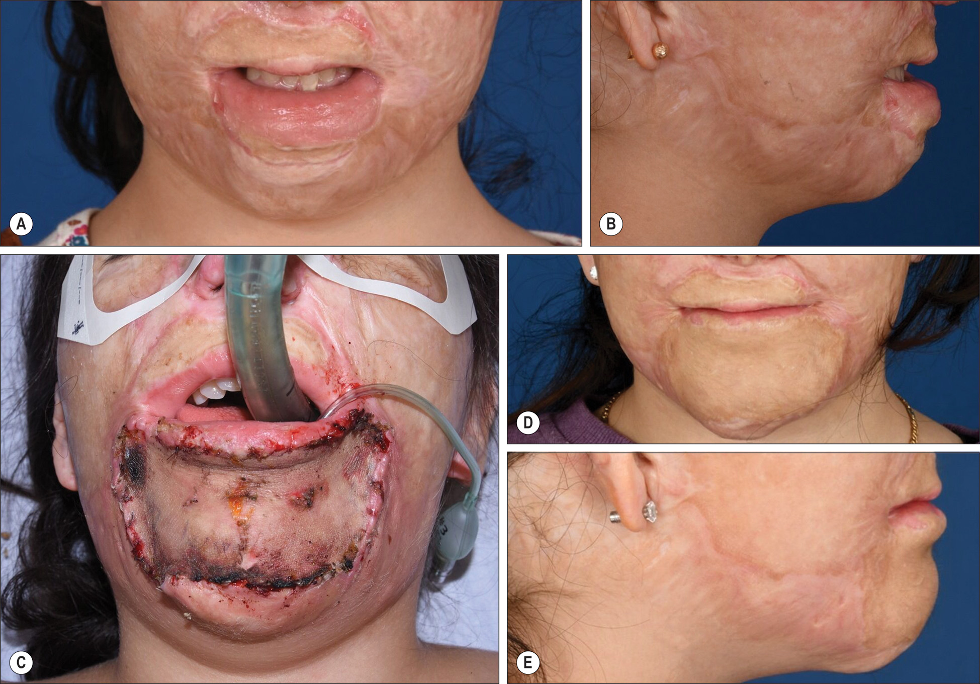 A photo series of 5 photos labeled A through E showing retracted lower lip from contractures with contracture release and full thickness skin graft to labiomental sulcus and chin. The photo series of 5 photos labeled A through E shows a retracted lower lip secondary to contractures with treatment progression. Photos A and B show a retracted lower lip secondary to contractures. Photo C shows contracture release with a full-thickness skin graft to the labiomental sulcus and chin. Photos D and E show 17 months after skin grafts with a normal lower lip position and reestablished labiomental sulcus.