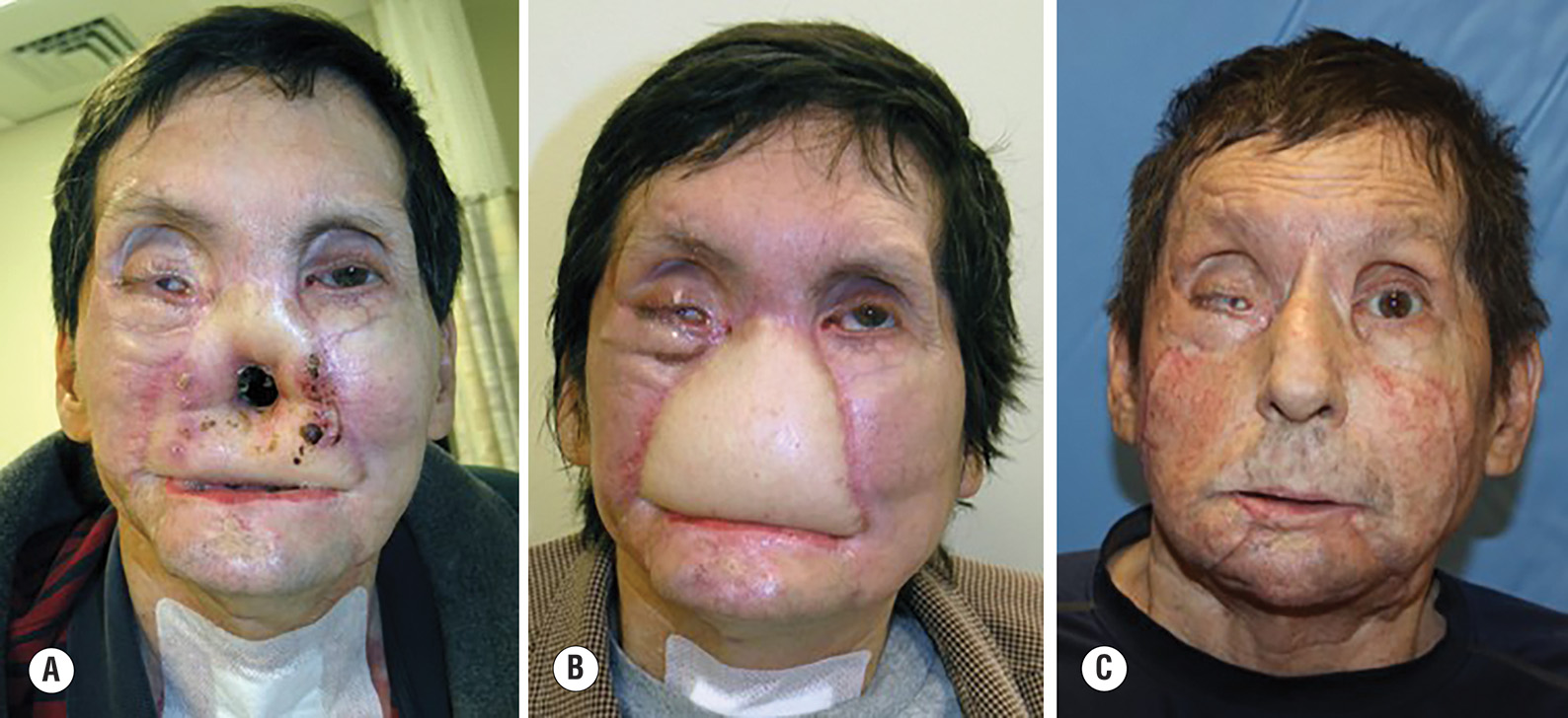 Three photos of a patient with facial electrical burns showing injury, flap reconstruction, and outcome after facial transplantation. The three photos document the treatment progression of a patient with severe electrical burns to the face. Photo A shows the facial injury after the electrical burn trauma. Photo B demonstrates the patient after undergoing anterolateral thigh flap surgery for midface coverage as an intermediate reconstructive step. Photo C depicts the outcome seven years after vascularized composite allotransplantation, showing the long-term results of facial transplantation surgery.