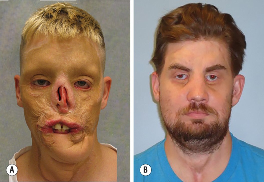 Two photos of a patient with facial burn injury before and after vascularized composite allotransplantation. The two photos show a patient with severe facial burn injury and subsequent reconstruction. Photo A demonstrates oral incompetence, ectropion, and total nasal defect after burn injury, following delayed and expanded trapezius free flap to the lower third of the face and neck. Photo B shows the patient three years after vascularized composite allotransplantation, depicting the restored facial features and functional improvements achieved through facial transplantation.