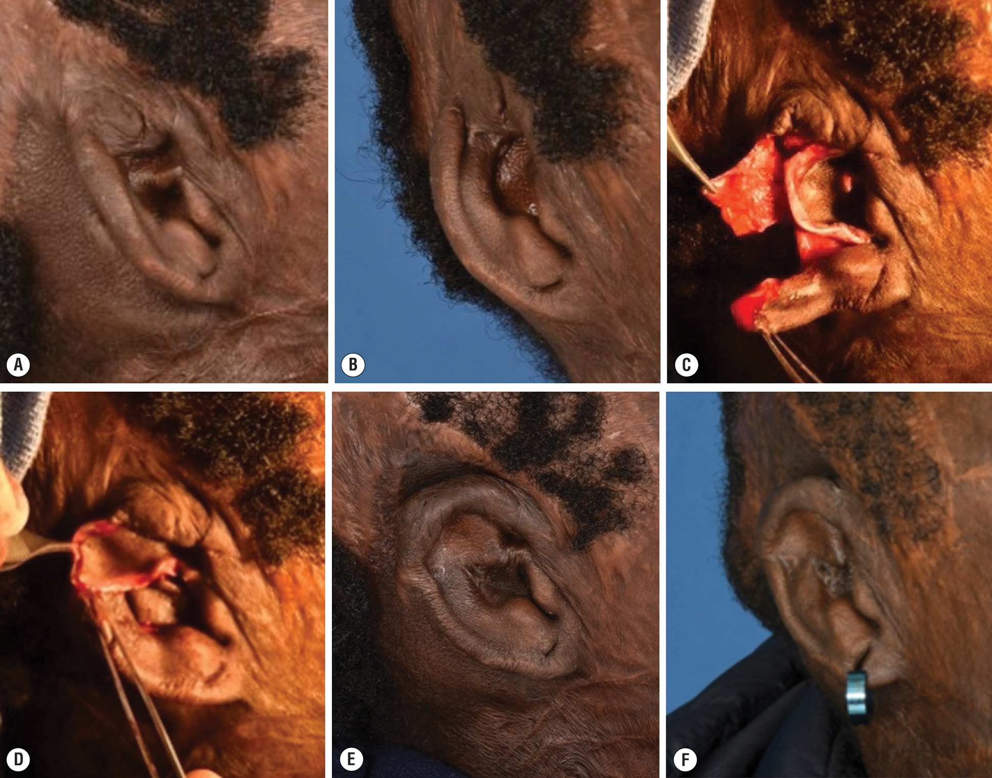 A photo series of conchal transposition flap surgery for auricular reconstruction in a patient with burn injury. The photo series demonstrates conchal transposition flap surgery for auricular reconstruction in an eleven-year-old male patient from Haiti who sustained an eleven percent total body surface area campfire flame burn injury to the head, neck, and face. Photos A and B show the patient six years after injury with a subtotal cartilage deficit in the superior aspect of the right helical rim. Photos C and D demonstrate the conchal transposition flap procedure in which the conchal bowl was incised along its full length, leaving a superior anterior pedicle, with the conchal cartilage rotated into position and covered with a retroauricular skin flap. Photos E and F depict sagittal and oblique views of the reconstructed ear three months after release and full-thickness skin grafting to the retroauricular space, performed one year after the conchal transposition flap to elevate the helical rim and further improve ear protrusion.