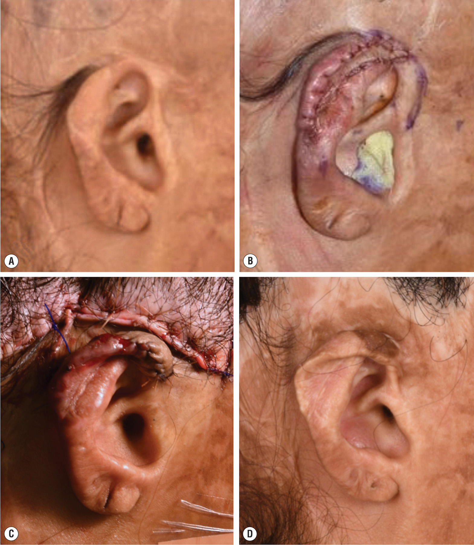 A photo series of conchal cartilage graft reconstruction for ear deformity in a patient with burn injury. The photo series demonstrates conchal cartilage graft reconstruction for ear deformity in a one-year-old female patient from the Dominican Republic who sustained a fifty percent total body surface area flame burn injury from a house fire. Photo A shows the patient thirteen years after the burn with a subtotal right ear cartilage deformity approximately four centimeters from the middle to the superior aspect of the helical rim. Photo B depicts stage one of helix reconstruction, where the patient underwent a retroauricular skin flap, and a composite conchal cartilage graft was harvested from the contralateral ear. Photo C demonstrates stage two completed four months later, with a full-thickness skin graft placed in the retroauricular sulcus to elevate the composite graft. Photo D shows a sagittal view of the reconstructive outcome three years after stage two.