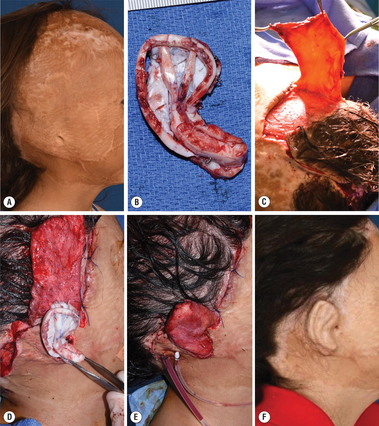 A photo series of costal cartilage graft reconstruction for total ear loss in a patient with burn injury and scalp alopecia. The photo series demonstrates costal cartilage graft reconstruction for total ear loss in a male patient who sustained a thirty percent total body surface area flame burn injury at the age of one year from a house fire in his home country, Libya. Photo A shows the patient ten years after the burn with severe scalp alopecia and complete loss of the right ear, with the external auditory meatus present but no cartilage remnant, and poor quality previously grafted overlying skin. Photo B depicts the harvested rib and synchondrosis utilized to sculpt a costal cartilage graft guided by a transparent film template of the contralateral ear, after five months of right temporal parietal occipital tissue expansion and resection of burn alopecia with hairline reconstruction. Photos C through E demonstrate the construct wrapped in an elevated temporoparietal fascia flap, sutured into position, and covered with a split-thickness skin graft. Photo F shows a sagittal view of the reconstructive outcome one year after costal cartilage graft placement, during which interval the patient underwent a Y to V advancement flap to address significant external auditory meatus contracture, and a full-thickness skin graft was applied to the retroauricular sulcus for construct elevation.