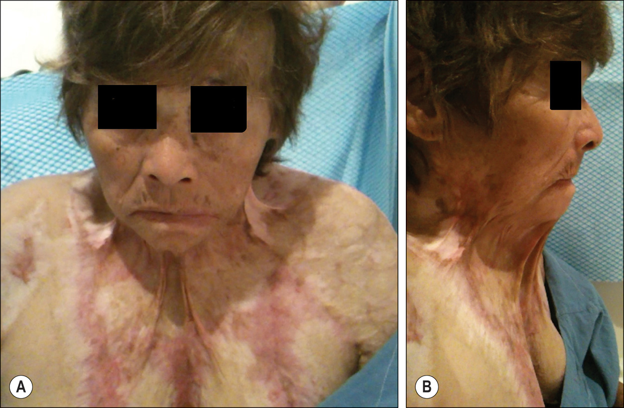 Two photos, labeled A and B, of a patient affected by a contracture band in different views. The photo on the left, labeled A, is a person's face and upper torso with severe burns and wrinkling. The skin from the neck to the chest appears very saggy. The neck and chin are undifferentiable due to heavy contraction bands. There is redness throughout as bands surrounded by a pale border. The photo on the right, labeled B, is a view of the same person from the right side, with the disappearance of a clear neck region. The eyes are obscured for privacy.