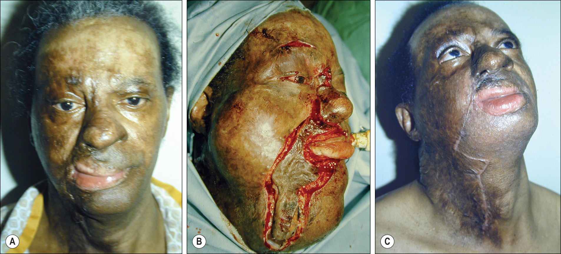 Three photos, labeled A to C, of a patient affected by a contracture band at different stages of treatment. Three photos show the face and neck region of a patient. The photo on the left, labeled A, shows a twisted lip on the face and a drooping facial appearance. The neck structure is also misaligned and contracted. The nose is aligned towards the right. The left cheek is slightly shrunken, while the right cheek is very slightly bulged. The middle photo, labeled B, is a side view, where an incision along the right eyelid continues to the right of the nose, further bifurcates to the lips and cheeks. From the cheek region, it extends to the neck and connects with the incision line from the upper lip that surrounds the lower lip and reaches the neck. The bifurcated paths run almost parallel to each other after the lower lip and converge. There is a tissue placed into the cheek and neck, making them appear like filled balloons on either side. The last photo on the right, labeled C, shows the person after closing the defect in a Z-shape from the neck to the cheek and further over the nose. The Z-shape faces the top right. The swelling of the cheeks and neck appears reduced. The lips, nose, and face appear normal than in the first photo.