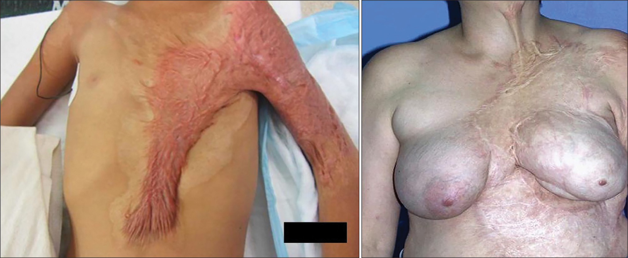 Two photos of the upper torso of two individuals with burn injuries. The left photo, in a hospital setting, is of the chest and arms with a black bar to obscure some details for privacy at the bottom. The person has a distinctly elevated scar that is from the stomach region and runs diagonally to the shoulder joint, further spreading to the upper left arm. The scar appears to have nerve-like thick elevations. The right photo, of a person standing in a blank background, focuses on the neck and upper torso. The breasts are saggy and misaligned. The left nipple has disappeared partially, with only a dot-like appearance. The entire left part of the torso is affected by less elevated scar formation without redness.