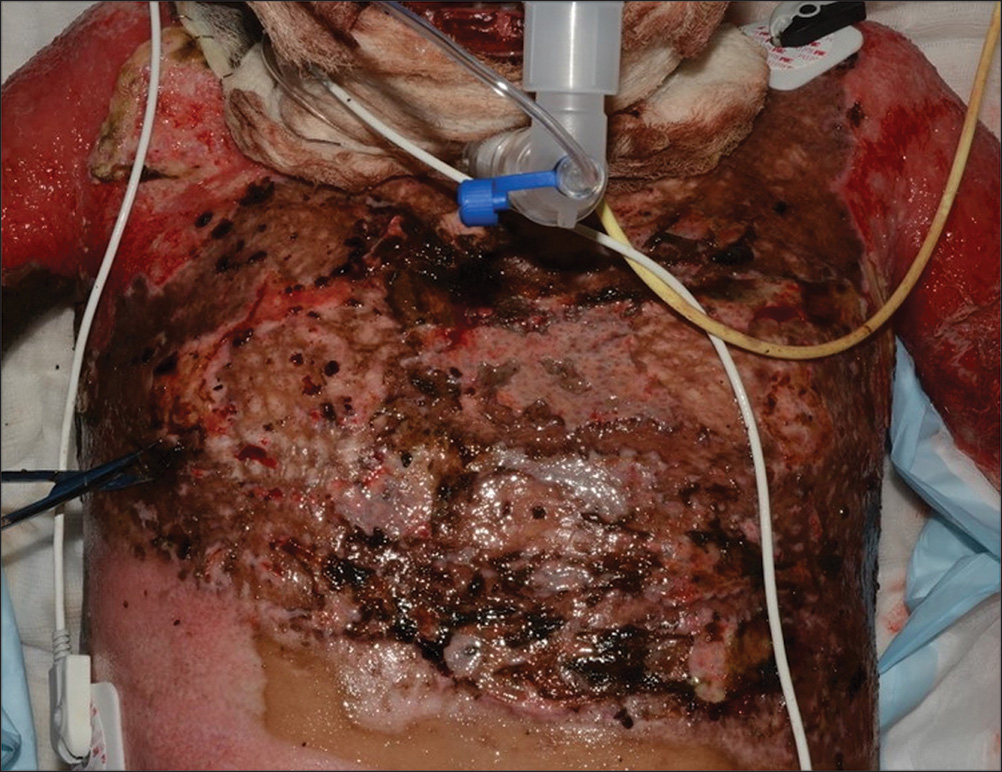 A photo of the upper torso of an individual with very severe burn injuries. The photo is in a hospital setting, where oxygen masks are worn by the patient and several other treatments are going on. The entire skin of the arm is peeled with redness, and the skin of the torso is also peeled then and there. The torso appears with redness and has many darkened areas due to high scarring. The breast region is mostly peeled and surrounded by a dark patch.