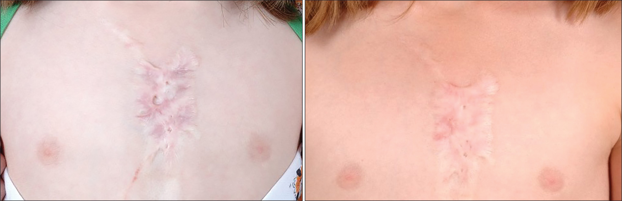 Two photos of the breast of an individual. The left photo has a pale band of burn injury running vertically across the centerline between the breasts. It appears puckered or tethered due to contracture. The right photo focuses on the same region. The right photo has less discoloration and puckering compared to the left photo.