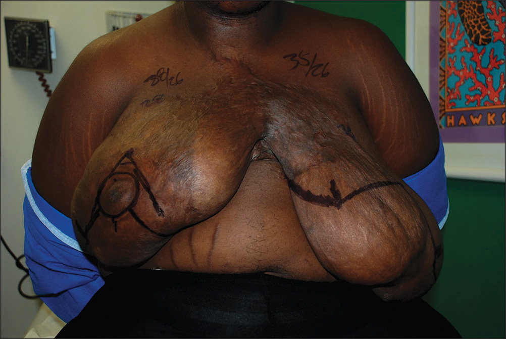 A photo of the upper torso of an individual with sagging breasts due to burn contractures. The photo shows the torso and arms tied to the back. The breasts are excessively enlarged and sagging heavily. The left breast is sagging more than the right breast. They are affected by scars that cause wrinkling in most areas, especially the left breast. Suture lines are marked and circle the areola of the right breast, and a few linear lines run outward from it. A few numbers are mentioned, like 88 slash 26 over the right breast and 35 slash 26 above the left breast. Another set of numbers, like 28, is written below these numbers.