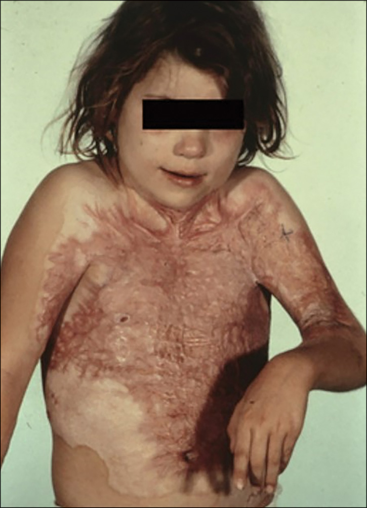 A photograph of a child's face and upper body with burn injuries. The child's entire upeer torso and mid-region of the stomach have complete scarring with very less normalcy. The scars radiate outward from the chest and the entire left arm and half of the upper right arm also have partial scars. There is an outline of pale tissue surrounding this extensive scarred tissue along the chest and hands. The left arm is bent 45 degrees and the region below the wrist id hanging in a saggy posture. The scars are slightly elevated and have redness throughout. The eyes are obscured with a bar for privacy. The face and the rest of the torso do not have any scars.