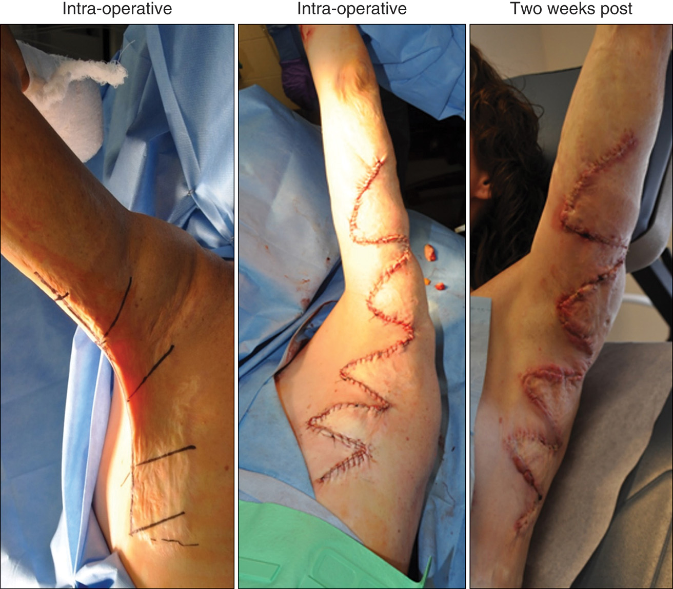 Three photographs of a person's arm from left to right are labeled intra-operative, intra-operative, and two weeks post. The photo on the left shows incision markings that are parallel. There are 2 markings on the torso's side, a third marking in the armpit, and a fourth on the upper arm. In the middle photo, there are zigzag sutures along the marked lines. In the last photo, the sutures are partially healed, and zigzag lines appear similar to the middle photo.