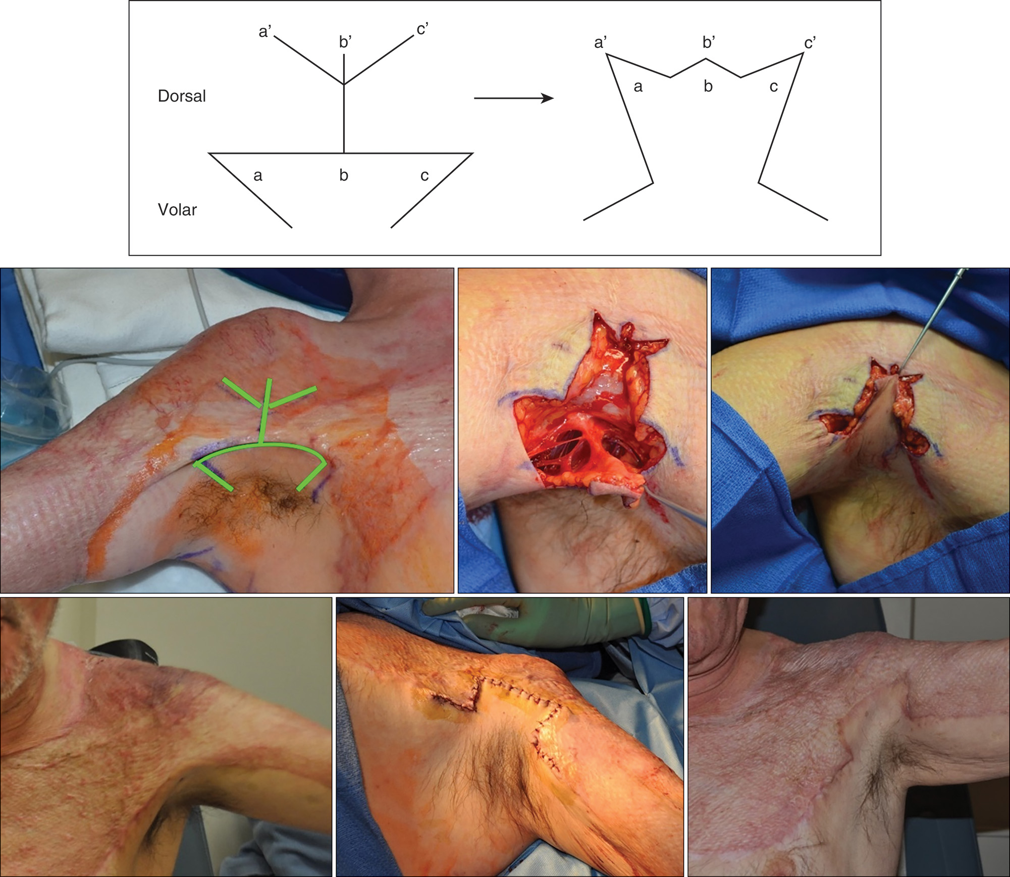 A diagram and a composite of six photos show burn reconstruction. The top left diagram illustrates the technique with flaps labeled a, b, c on the base labeled volar. The base is in the shape of half of an inverted triangle labeled with sides a, b, and c. The base is bound to a stick on top, labeled dorsal that branches into 3 sticks a prime, b prime, and c prime. An arrow from this diagram leads to a diagram with zigzag line on top labeled with a prime, b prime, c prime on top and a, b, c below. From the ends of the zigzag line, two lines converge and then diverge. Below, there are 6 photos. The first photo is before surgery and marked with computerized incision lines. The next photo is intraoperative, where incision is made, skin flaps elevated and tissue is exposed forming the shape of diagram on top left. Blood vessels are exposed. The next photo is also intra-operative, where the skin flap is being closed amd the shape is similar to the top right diagram. A needle is passing through the flap. The next photo shows a post-operative front view where flap closure is depicted with minimal suture lines. The next photo is a close-up of the armpit with suture lines in the form of a rectangular flap. The last photo is a front view of the raised hand and torso with maximal healing of wound and suture threads disappeared.