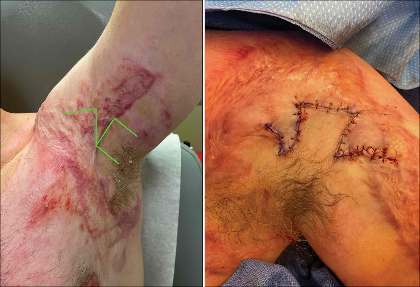 Two side-by-side photographs show the armpit of a person with a raised hand and a lowered hand, respectively. The left photo is a pre-operative photo and the right one is a post-operative photo. In the left photo, there is a high amount of scarring of the tissue surrounding the armpit. A computerized incision marking is shown in the shape of an arrowhead placed over a square without base. In the riht photo, post-operative sutures are in the shape of a square without base and extension lines on either side from the bottom.