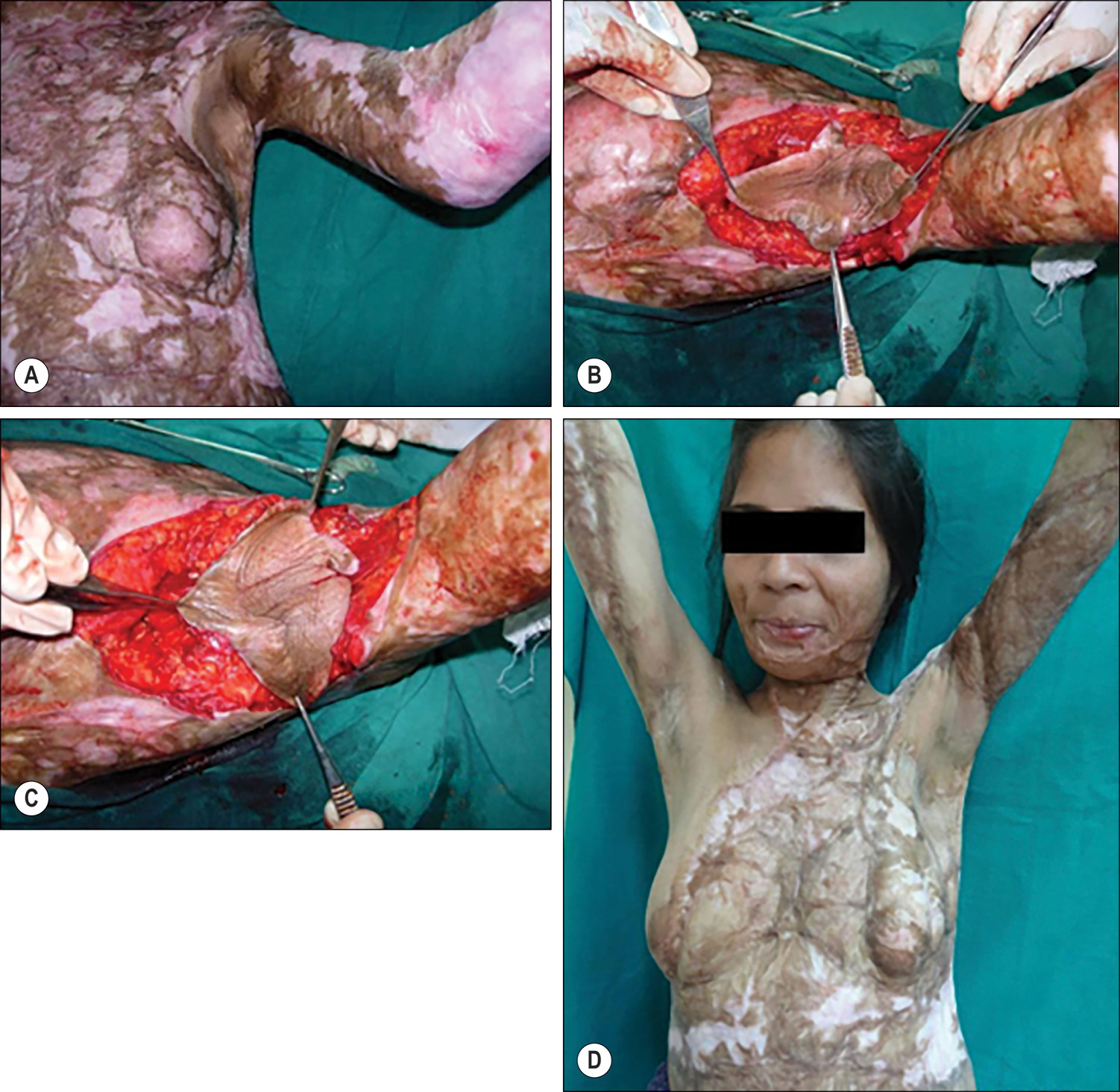 Four photographs of a person, labeled A to D, in different stages before and after surgery. A pre-operative photo, labeled A, shows the left torso of an individual with a half-raised arm and redness in scars throughout the torso. The contracture spans the axillary dome with severe scarring of the surrounding tissues. Photo B shows a close-up of armpit. A quadrilobed flap is raised in the central depression of the armpit using surgical instruments like forceps. Photo C shows the same region as B with the flap twisted in the exposed skin to 90 degrees compared to B. Photo D is the upper torso of the person post surgery with arms raised and no redness. The scars have changed to pale skin.