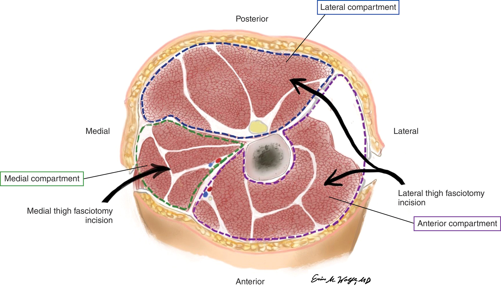 A labeled diagram illustrates a cross-section of the thigh showing the muscle compartments and the planned fasciotomy incisions, oriented in anterior, posterior, medial, and lateral sides. The labeled diagram illustrates a cross-section of the human thigh, depicting various muscle groups and anatomical structures. The four sides are labeled involving posterior on the top, lateral on the right, anterior on the bottom, and medial on the left. The main muscle groups are separated into three regions, labeled with dashed boxes: the upper portion is the Lateral compartment, the lower right portion is the Anterior compartment, and the lower left portion is the Medial compartment. The central bone is visible, surrounded by muscles. Two curved arrows originating from the periphery indicate the surgical approaches, with the incision on the left labeled Medial thigh fasciotomy incision and the incision on the right labeled Lateral thigh fasciotomy incision. Dashed lines outline the boundaries of the compartments. The bottom right side of the diagram involves a signature of Erine Wolf, M.D.