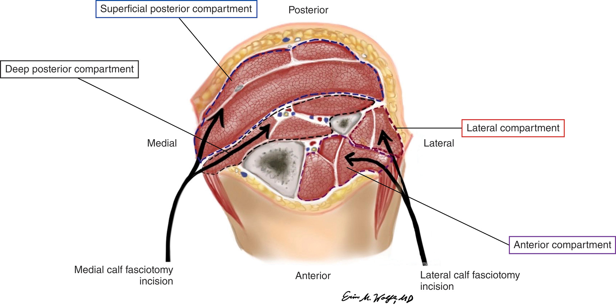 A diagram illustrates a cross-section of the lower leg, showing four muscle compartments and two proposed fasciotomy incision lines with orientations labeled Anterior, Posterior, Medial, and Lateral. The diagram illustrates a cross-section of the lower leg, with the central bones surrounded by muscle groups. The four muscle compartments are labeled with boxes: the large posterior muscles are divided into the Superficial posterior compartment and the Deep posterior compartment, while the smaller anterior muscles are labeled the Lateral compartment and the Anterior compartment. Two thick curved arrows, originating from the skin on the left and right sides, point toward the fascial tissue surrounding the muscles, indicating the surgical approaches. The arrow on the left is labeled Medial calf fasciotomy incision, and the arrow on the right is labeled Lateral calf fasciotomy incision. The four sides are labeled involving posterior on the top, lateral on the right, anterior on the bottom, and medial on the left. The bottom right side section of the illustration shows the signature of Erin Wolf, M.D.