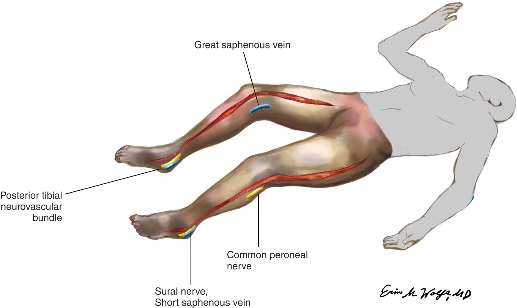 An illustration of a patient lying down presents the superficial anatomy of the lower extremities. Key anatomical structures in the legs are highlighted and labeled, including major nerves and veins. The illustration depicts a supine patient with the legs extended and slightly bent at the knees. The anatomical structures of the lower extremities are highlighted and labeled with lines. The Great saphenous vein is marked on the upper thigh. The Posterior tibial neurovascular bundle is marked near the ankle. The Common peroneal nerve is marked on the lower leg. The Sural nerve, the Short saphenous vein, is marked near the heel and ankle. The illustration is signed by Erin Wolf, M.D., depicted on the bottom right side.