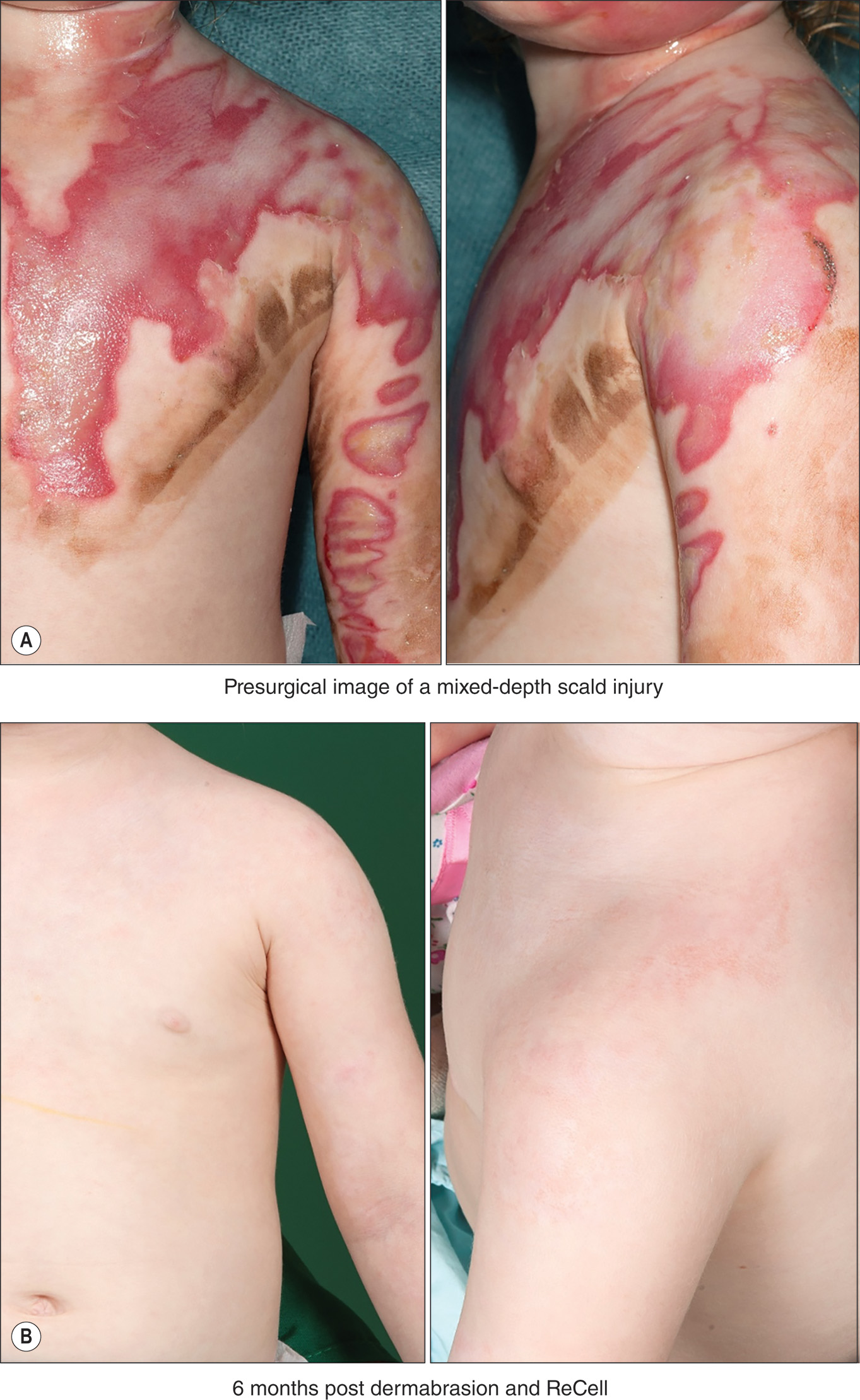The photo displays a presurgical mixed-depth scald injury on the torso and arm, showing irregular patches of tissue damage and burns of varying depths on the chest, shoulder, and upper arm. A photo of healed skin 6 months after dermabrasion and ReCell treatment. The photo shows healed skin 6 months post-dermabrasion and ReCell treatment. The photo is split into two views showing the back and shoulder area. The treated areas demonstrate healed tissue with minimal scarring across the upper back, shoulder blade, and upper arm regions following the regenerative skin procedure.