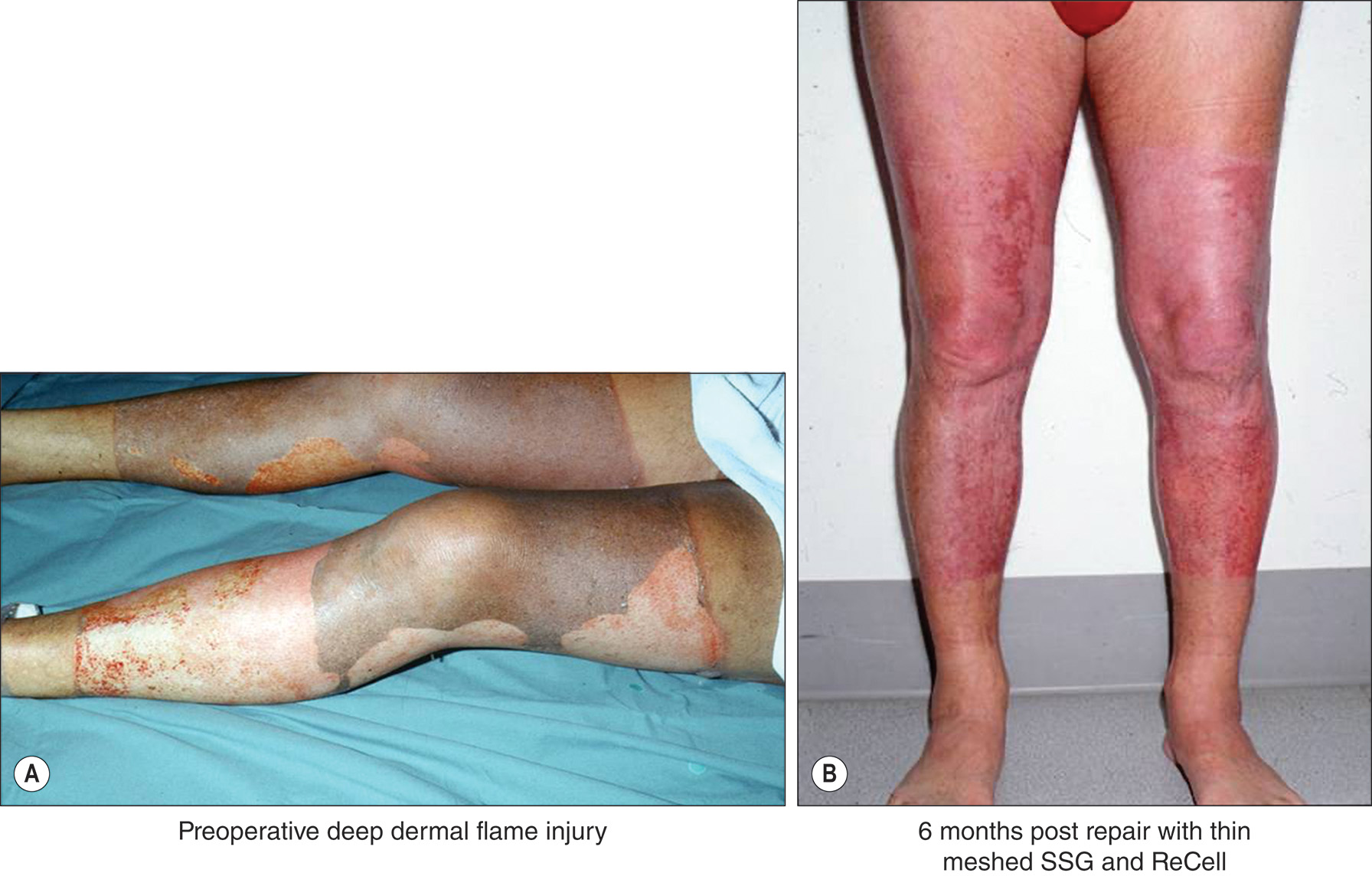 A photo of a preoperative deep dermal flame injury on legs. A photo of healed legs 6 months after repair with thin meshed split thickness skin graft and ReCell. The photo shows a preoperative deep dermal flame injury on both legs. Two lower limbs rest on a medical surface. The burns extend across the anterior and lateral aspects of both legs from the thighs down to the ankles, showing areas of deep dermal tissue damage from flame exposure. The photo shows healed legs 6 months post repair with thin meshed split thickness skin graft and ReCell treatment. The photo displays both lower limbs from the posterior view, showing the backs of the thighs, calves, and ankles. The treated areas demonstrate healed skin with a mesh pattern from the grafting procedure extending across both legs from the buttocks down to the ankles.