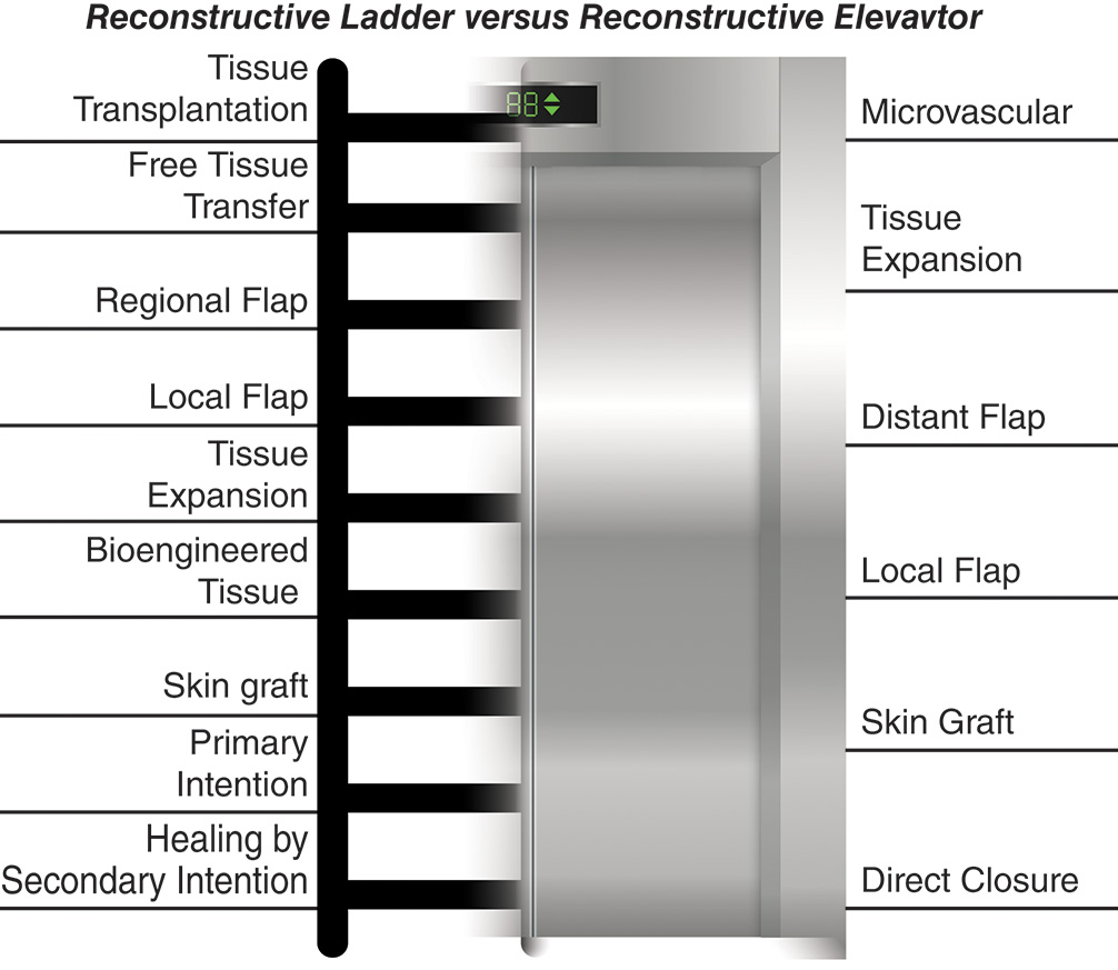 An illustration titled reconstructive ladder versus reconstructive elevator. The diagram is a merged illustration of a half ladder on the left and a half elevator on the right. On the left of the ladder, there are lines listing the following from the top. Tissue transplantation, free tissue transfer, regional flap, local flap, tissue expansion, bioengineered tissue, skin graft, primary intention, and healing by secondary intention. On the right of the elevator, there are lines listing the following. Microvascular, tissue expansion, distant flap, local flap, skin graft, and direct closure.