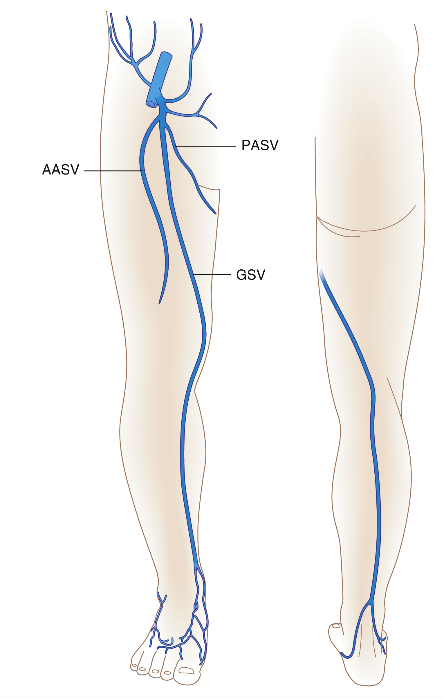 A diagram of both legs shows the anterior and posterior accessory saphenous veins and the great saphenous vein. The diagram features both legs. The left leg view shows labeled veins, including the anterior accessory saphenous vein marked as A A S V, the posterior accessory saphenous vein marked as P A S V, and the great saphenous vein marked as G S V. These veins are illustrated as lines following the contours of the leg. The great saphenous vein extends from the foot upward along the medial leg and thigh. The anterior and posterior accessory saphenous veins branch near the thigh and upper leg.