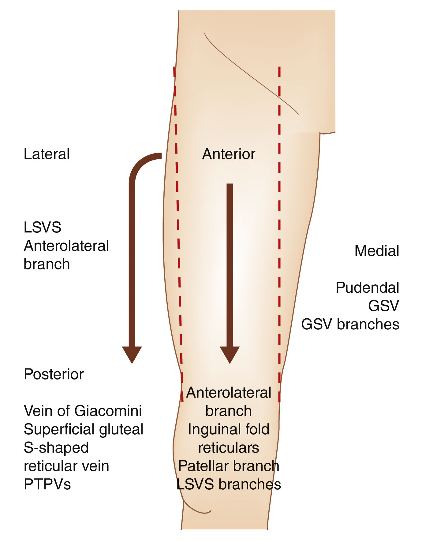 A labeled diagram of the thigh shows labeled venous compartments and branches. The labeled diagram of a thigh in vertical orientation includes directional markers for anterior, posterior, medial, and lateral. A dashed arrow runs vertically down the anterior midline, labeled the great saphenous vein. To the lateral side, the lateral subdermic venous system is labeled, along with its anastomotic branch. On the posterior side, the vein of Giacomini and the posterior lateral thigh perforating vein are labeled. On the medial side, the diagram shows potential great saphenous vein branches and an intersaphenous anastomosis.