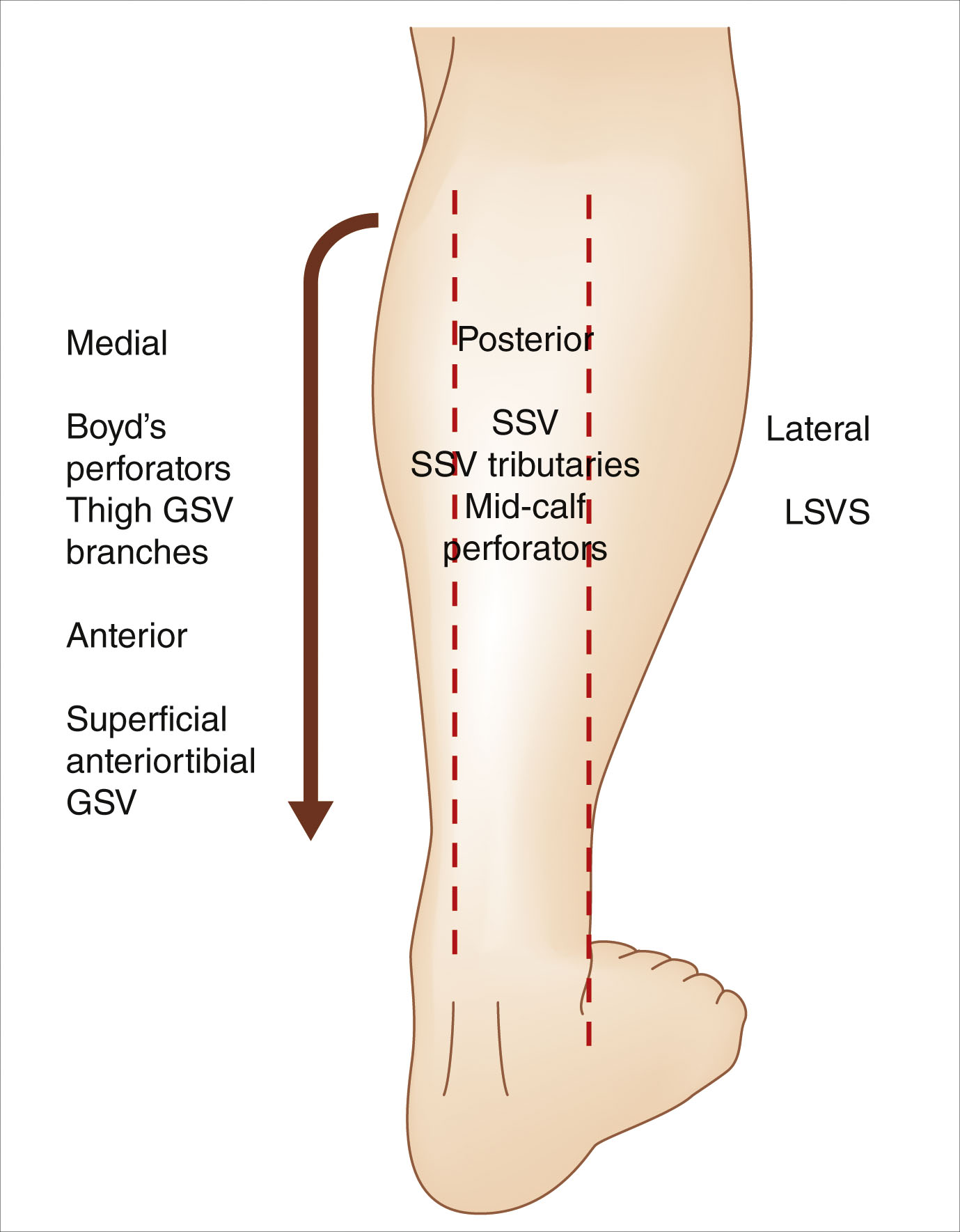 A labeled diagram of the calf shows labeled venous compartments and vascular branches. The labeled diagram of a lower leg in vertical orientation includes directional markers for medial, lateral, anterior, and posterior. A dashed line runs along the medial aspect of the leg, labeled the great saphenous vein. The lateral side includes the label L S V S for the lateral subdermic venous system. Near the midline on the posterior side, the small saphenous vein is labeled, along with its anastomosis with the great saphenous vein. The anterior side shows the superficial anterior tributaries of the great saphenous vein. A curved arrow on the posterior side indicates the direction of venous flow upward.