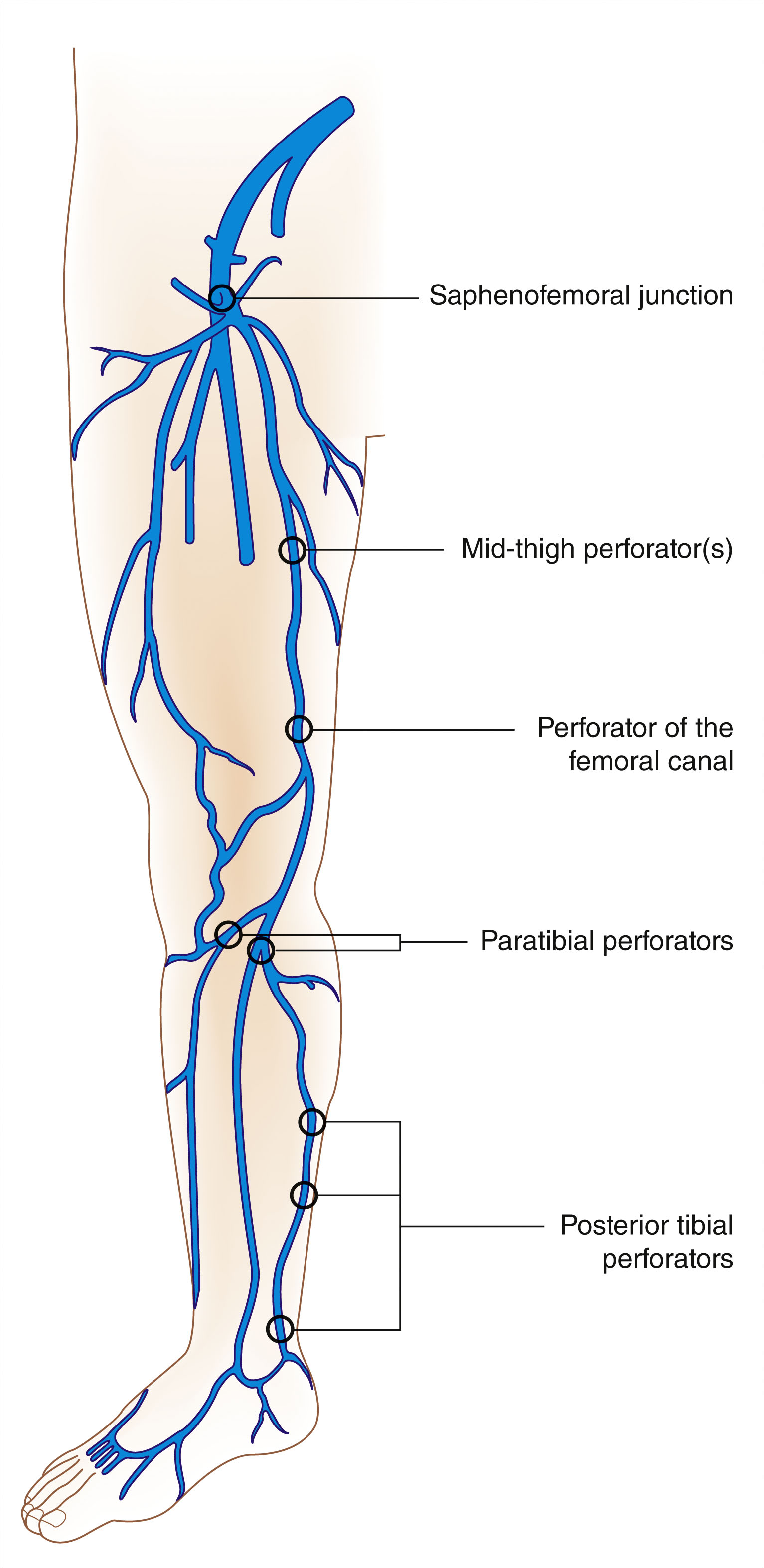A full leg diagram shows labeled clinically important perforating veins. The full-length diagram features the lower limb, displaying the superficial and deep veins, along with five labeled perforating veins. At the upper thigh, the saphenofemoral junction is marked. Moving downward, the mid-thigh perforators, the perforator of the adductor canal, and the perforator of the calf are labeled along the medial side of the leg. Near the ankle, the posterior tibial perforators are labeled. The diagram outlines the vertical venous axis and highlights specific perforating veins that connect superficial veins to deep veins. Each labeled perforator is positioned to indicate anatomical relevance along the length of the limb.
