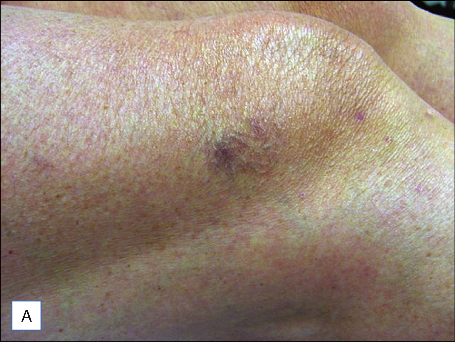 Two photos compare the skin views showing telangiectasia under different lighting conditions. The two photos are labeled A and B. Panel A shows a patch of skin with faint, branching telangiectasia visible near the center under standard lighting. Panel B shows the same area with the telangiectasia appearing more defined and clustered under enhanced lighting.