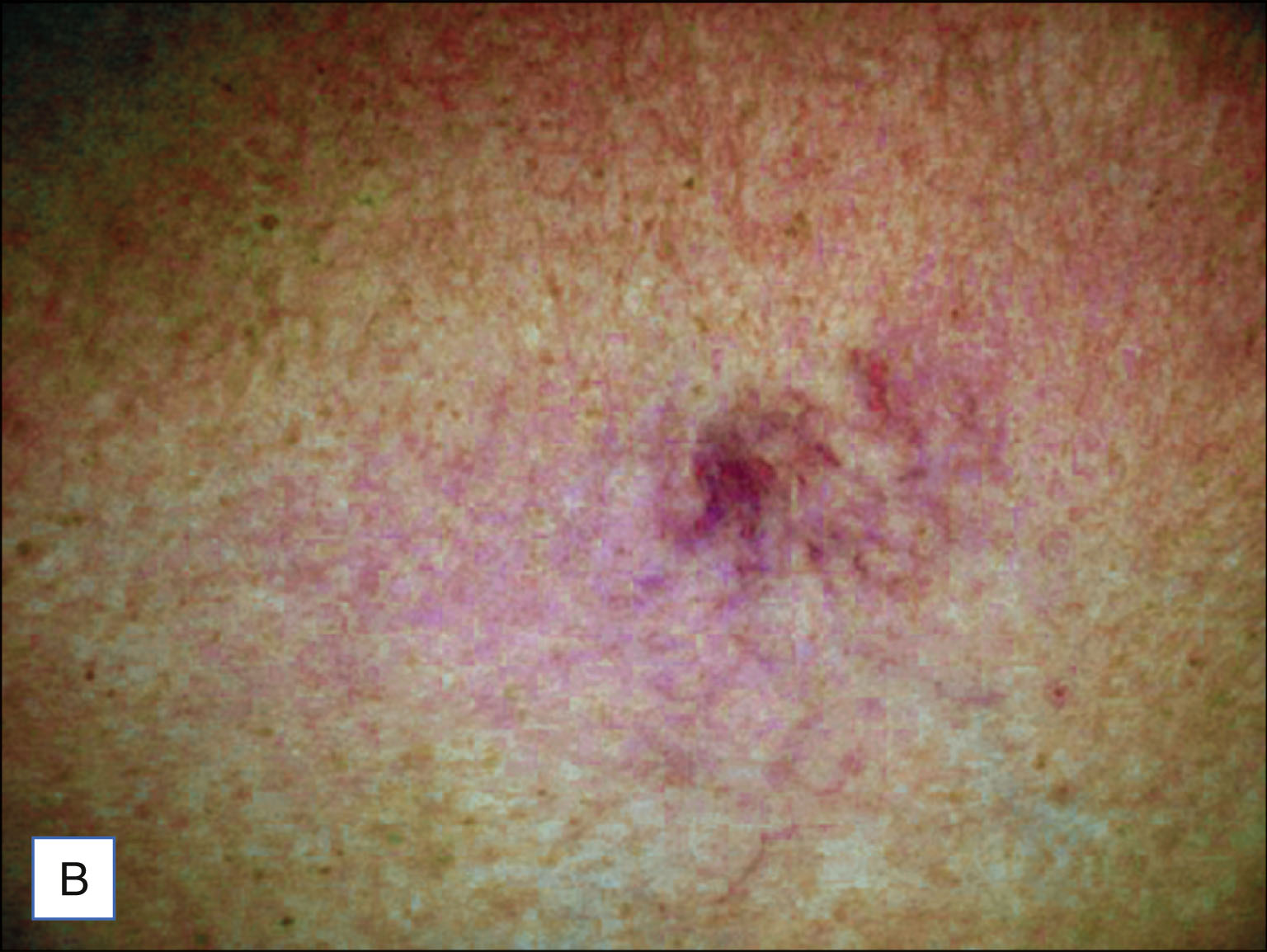 Two photos compare the skin views showing telangiectasia under different lighting conditions. The two photos are labeled A and B. Panel A shows a patch of skin with faint, branching telangiectasia visible near the center under standard lighting. Panel B shows the same area with the telangiectasia appearing more defined and clustered under enhanced lighting.
