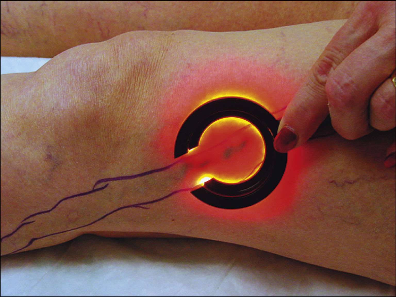 A photo shows a transillumination device applied to a leg, highlighting a reticular varicosity beneath the skin.