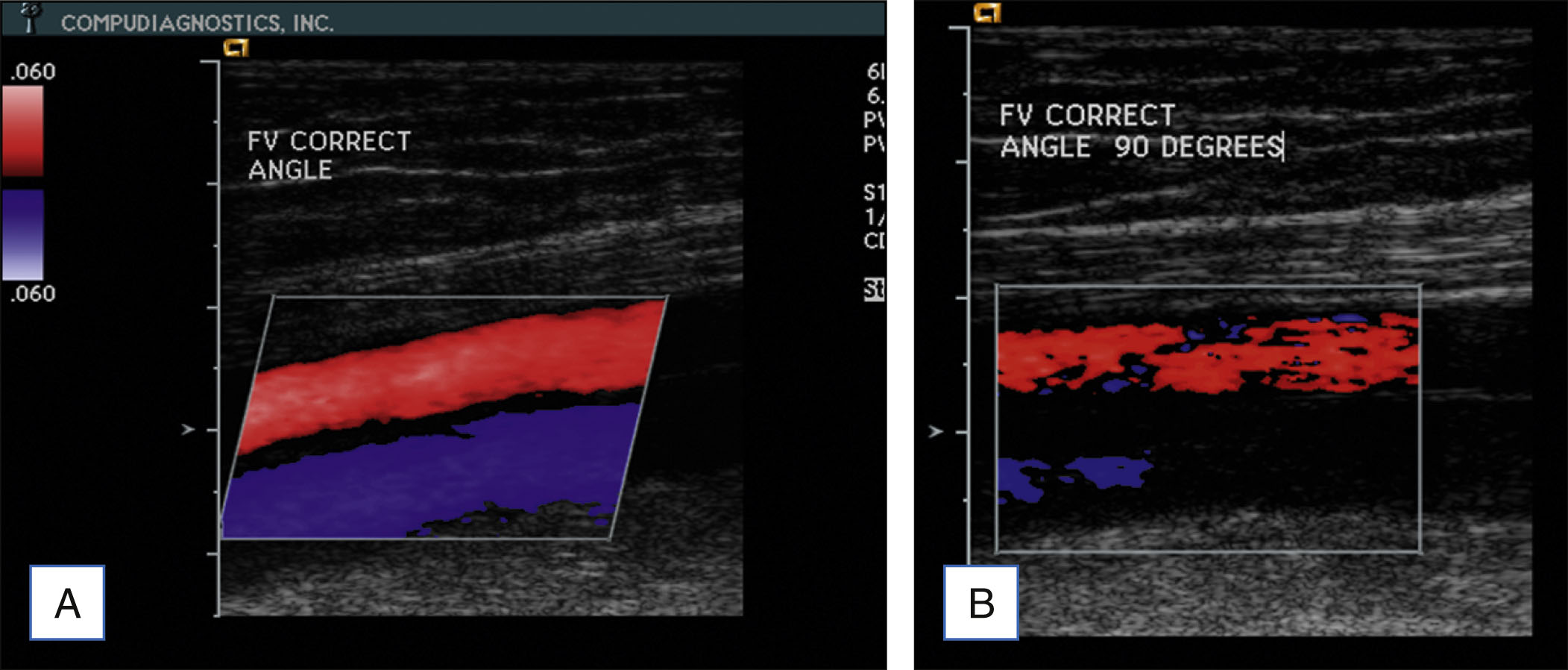 Two side-by-side ultrasound images compare the flow in vessels at different box angles. Two side-by-side ultrasound panels labeled A and B display longitudinal duplex scans with flow-coded signals within a vessel. In panel A, the flow box is angled and overlays a vessel that shows continuous bidirectional flow, labeled P W correct angle. A vertical scale on the left shows a small flow bar from top to bottom with labels 0 4 0 and 0. In panel B, the box is not angled and labeled P W; the correct angle is 90 degrees. The vessel appears more fragmented, with areas lacking flow.
