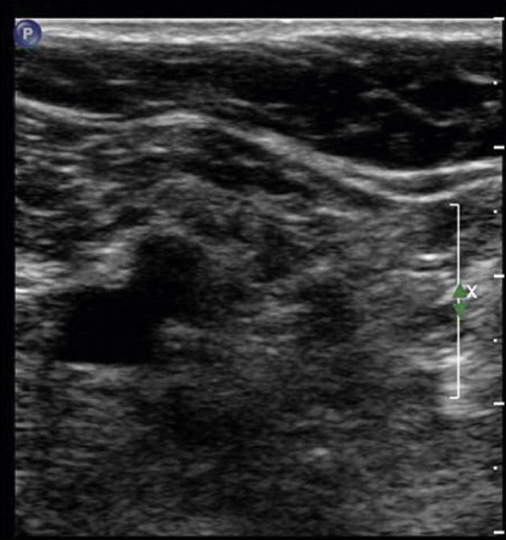 An ultrasound scan shows two round structures in a transverse cross-section of soft tissue. The ultrasound scan features a cross-sectional view of soft tissue with two adjacent, round, anechoic structures positioned horizontally. The upper part of the scan shows layered soft tissue, while the lower portion includes deeper structures with mixed echogenicity. A vertical measurement marker with a caliper is placed along the right side of the scan, aligned with one of the circular areas.