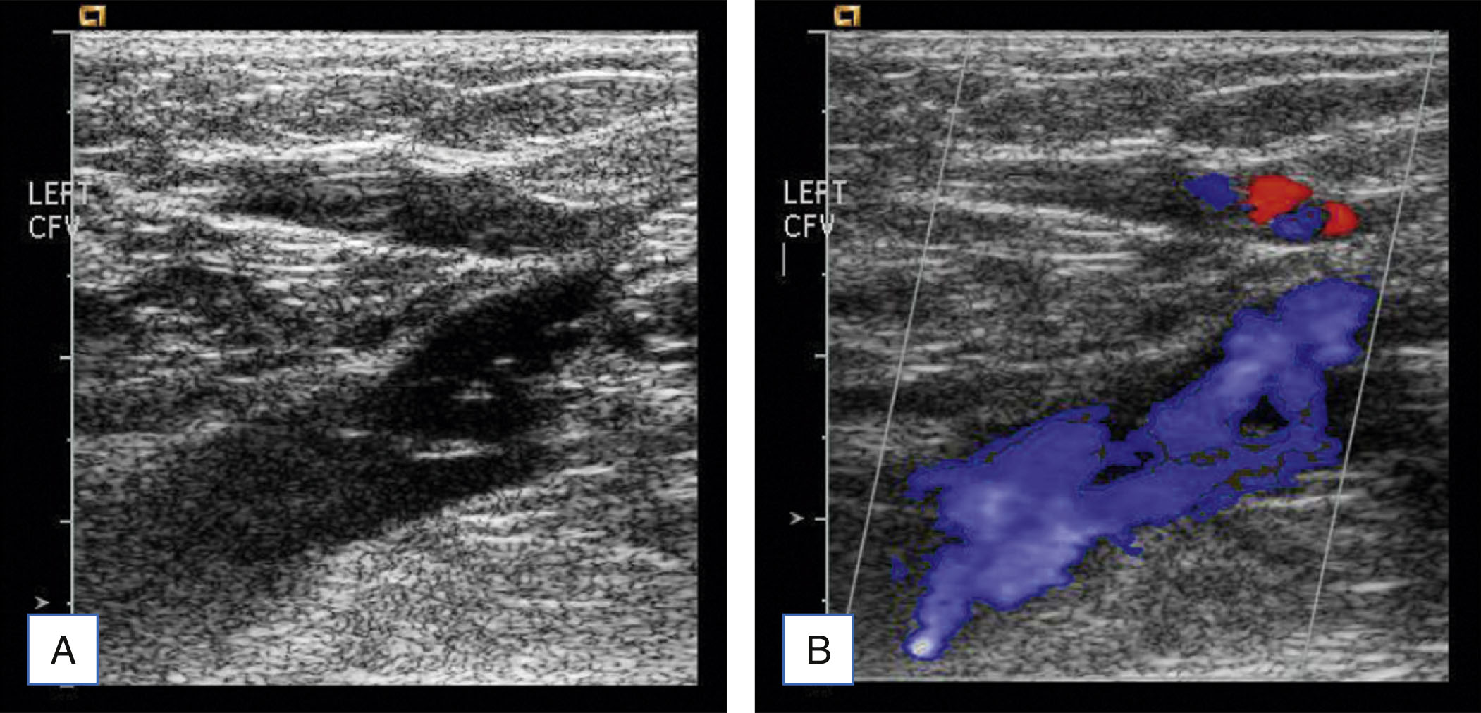 A two-panel ultrasound shows a longitudinal grayscale view and a flow scan of the left common femoral region. The two-panel ultrasound scan is labeled A and B, displaying longitudinal views of the left common femoral region. In panel A, the grayscale scan shows an elongated vessel labeled LEFT C F with irregular internal echogenic patterns filling part of the lumen. In panel B, the same vessel appears with a flow overlay. The lower portion of the lumen contains scattered flow signals, while the upper area shows small areas, with much of the lumen lacking flow signals.
