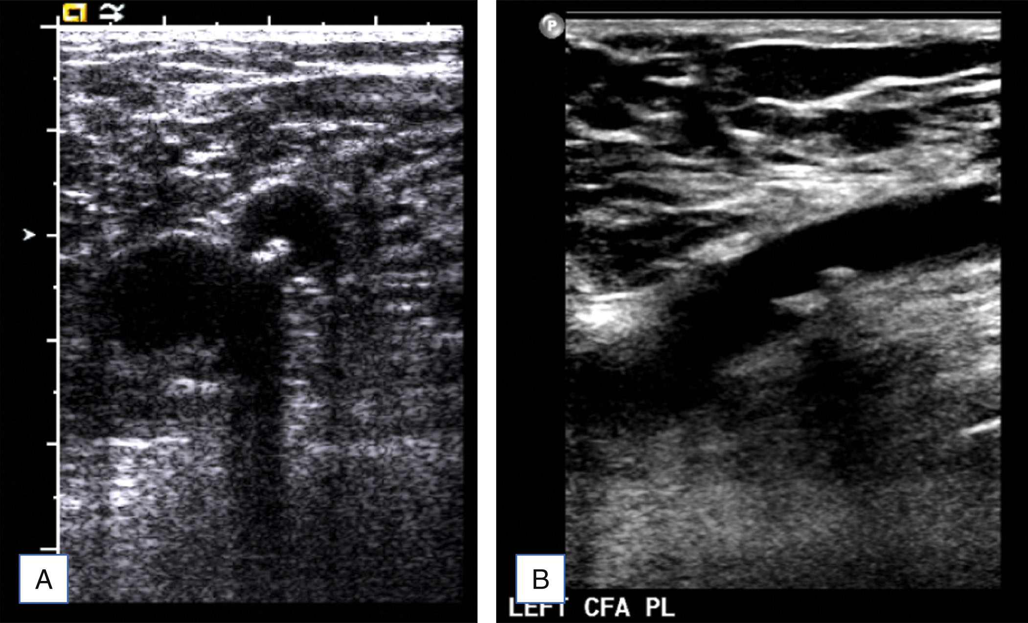 A two-panel ultrasound displays transverse and longitudinal grayscale views of the left common femoral artery. The two-panel ultrasound scan is labeled A and B. In panel A, a transverse scan displays a rounded vessel with small bright spots along the inner wall and an adjacent vessel structure below. The upper soft tissue layers appear layered with subtle striations. A vertical depth scale is visible on the left. In panel B, a longitudinal scan labeled LEFT C F A P L shows an elongated vessel running diagonally across the scan. Bright, dense spots are present along the deeper wall of the vessel. Surrounding soft tissue appears heterogeneous and layered without additional annotations.