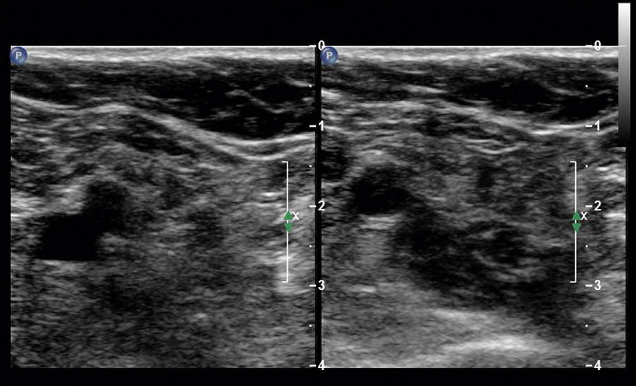 A dual-panel transverse ultrasound compares two soft tissue scans with and without probe compression. The dual-panel ultrasound scan presents two transverse views of soft tissue placed side by side. Both panels show layered superficial and deeper tissue with a vertical depth scale along the right of each panel, numbered from 0 to 4. In both panels, caliper markers are aligned vertically near the center. The left panel displays a rounded anechoic structure near the center, while the right panel shows a more compressed appearance in the same region. The soft tissue layers and texture differ subtly between the two panels.