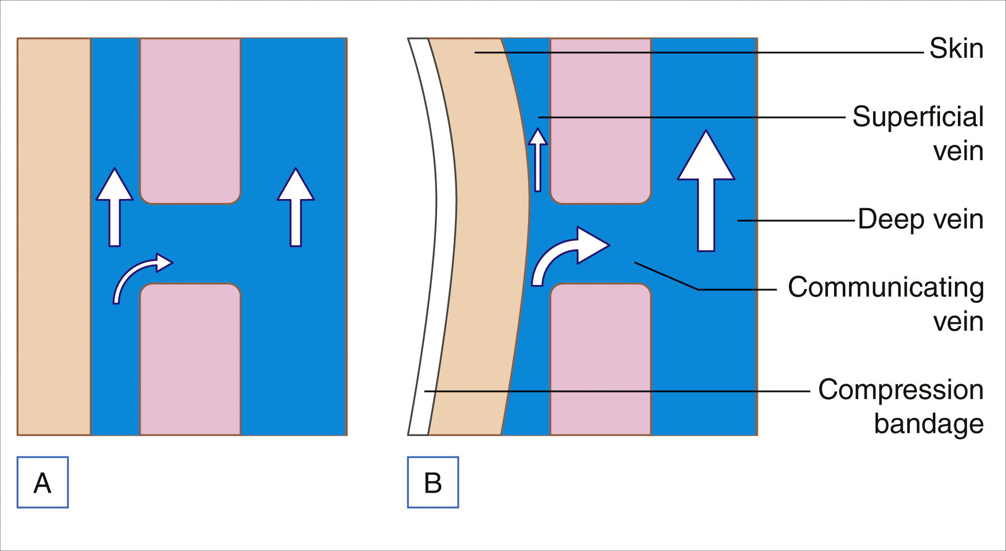 Two panels compare the venous flow before and after compression, with arrows indicating direction changes between superficial and deep veins. The two panels are labeled A and B. Panel A shows a superficial vein and a deep vein connected by a communicating vein, with arrows indicating upward flow in both superficial and deep veins. Panel B shows the same structures with an added compression bandage applied externally over the skin. In this panel, the superficial vein flow is redirected through the communicating vein into the deep vein, indicated by curved and straight arrows.