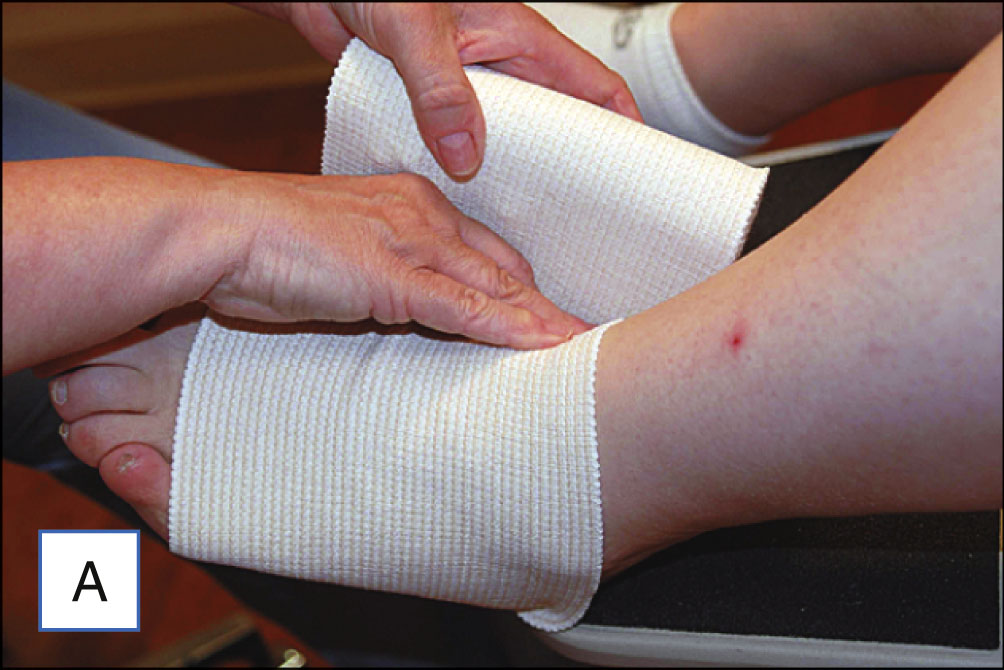 Three photo panels show a stretch bandage being applied step-by-step to a patient’s leg following a medical procedure. The three photo panels are labeled A to C. Panel A shows a partially wrapped lower leg with a stretch bandage that begins at the ankle and covers the lower calf. Panel B shows a person wrapping the bandage upward over the knee while the patient sits with the leg extended. Panel C shows the entire leg wrapped with the stretch bandage from the toes to above the knee.