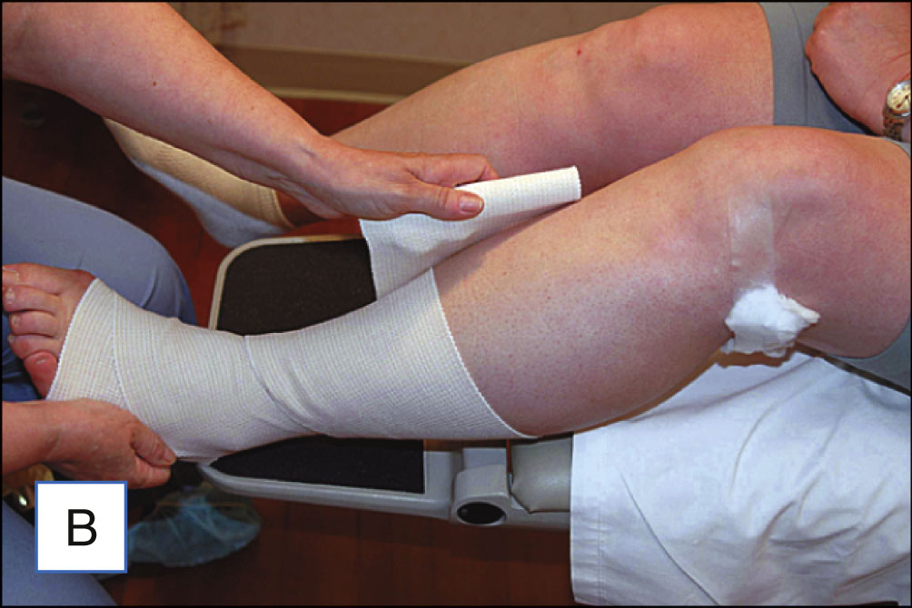 Three photo panels show a stretch bandage being applied step-by-step to a patient’s leg following a medical procedure. The three photo panels are labeled A to C. Panel A shows a partially wrapped lower leg with a stretch bandage that begins at the ankle and covers the lower calf. Panel B shows a person wrapping the bandage upward over the knee while the patient sits with the leg extended. Panel C shows the entire leg wrapped with the stretch bandage from the toes to above the knee.