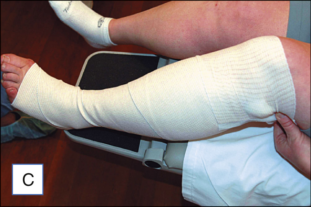 Three photo panels show a stretch bandage being applied step-by-step to a patient’s leg following a medical procedure. The three photo panels are labeled A to C. Panel A shows a partially wrapped lower leg with a stretch bandage that begins at the ankle and covers the lower calf. Panel B shows a person wrapping the bandage upward over the knee while the patient sits with the leg extended. Panel C shows the entire leg wrapped with the stretch bandage from the toes to above the knee.